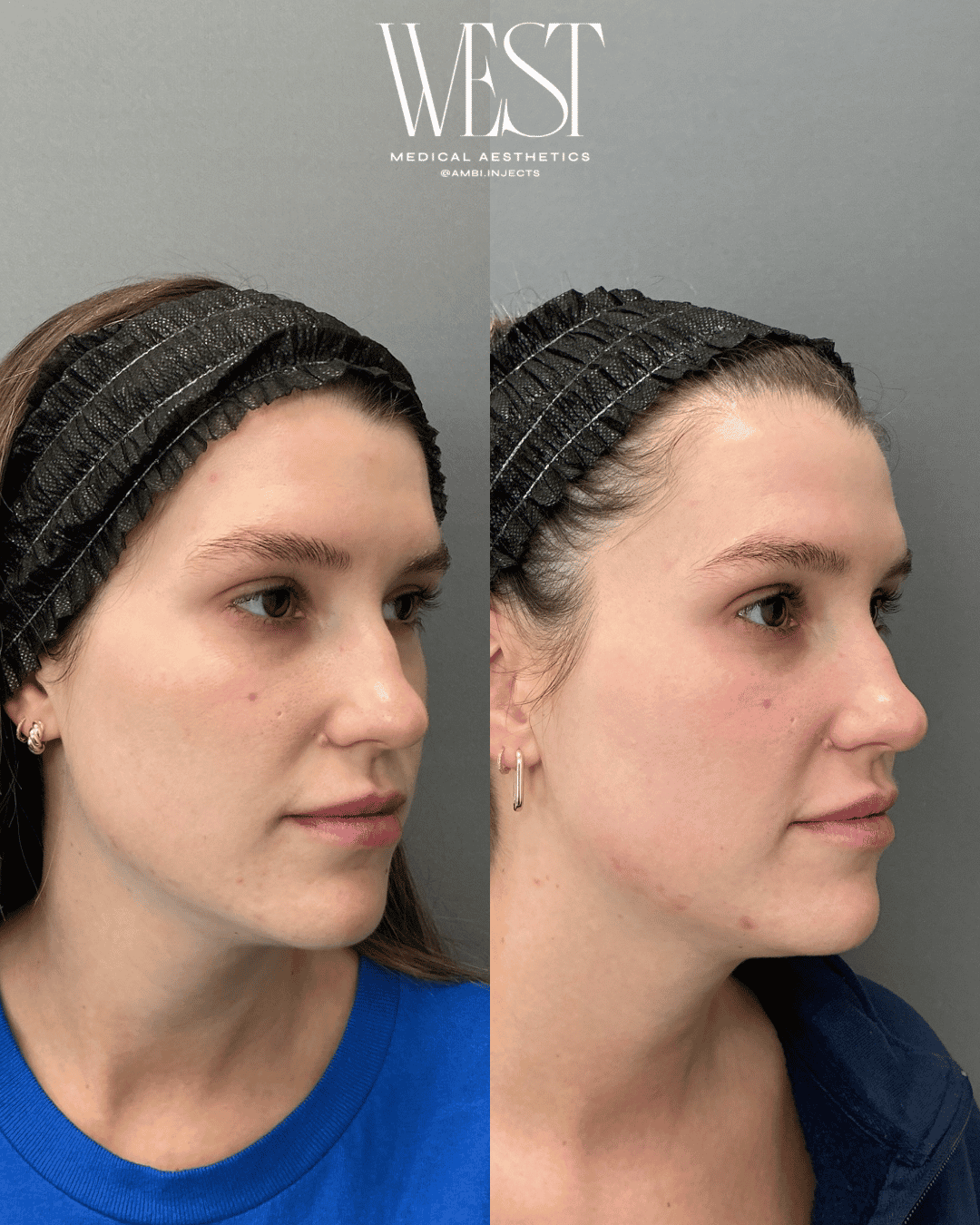 Laser skin treatment in okc