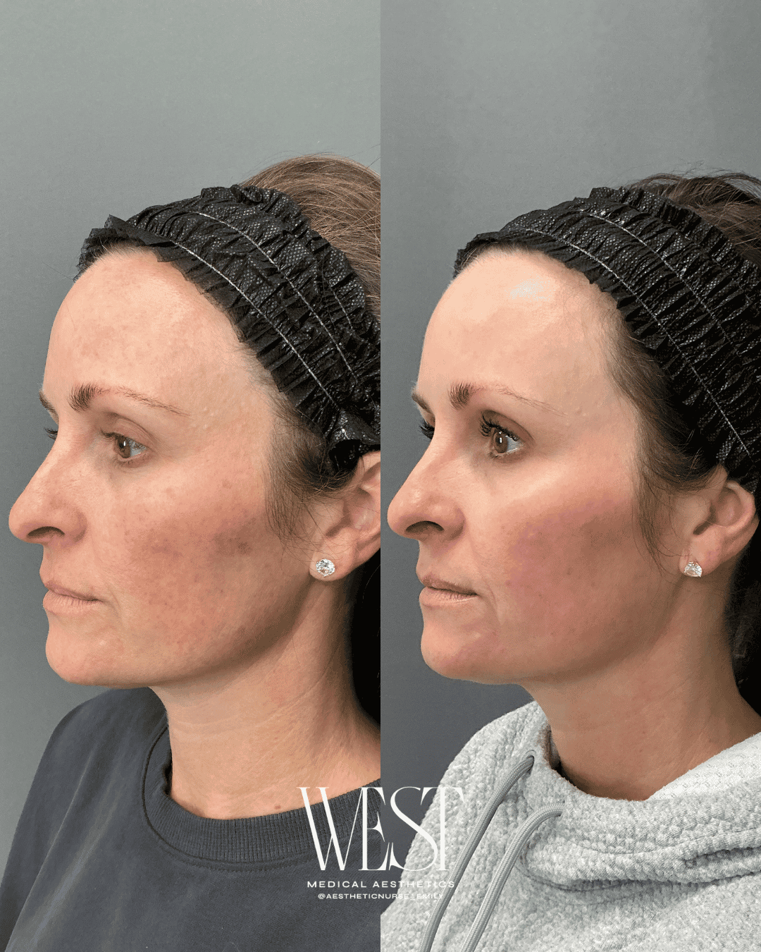 Moxi laser skin treatments in OKC