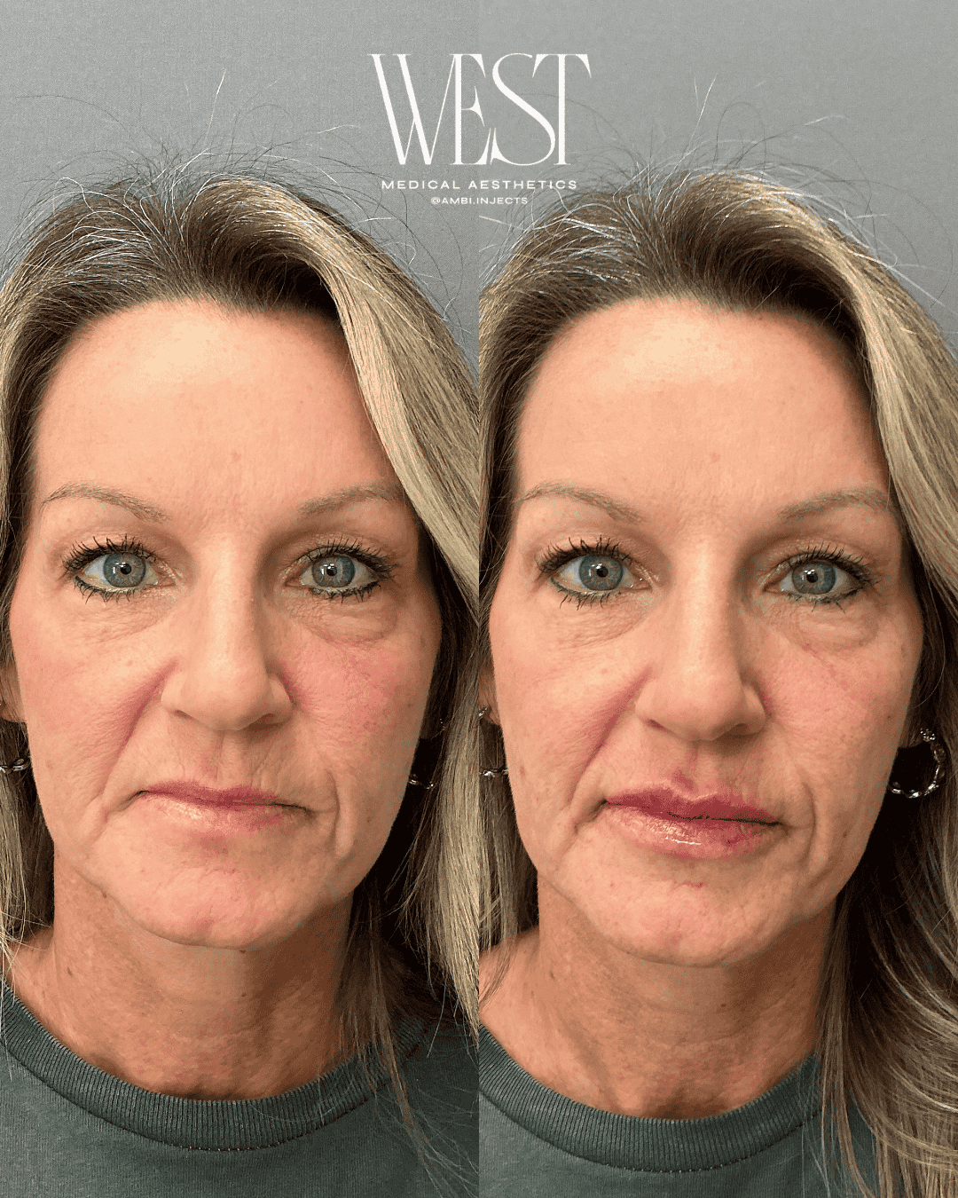 best lip filler in oklahoma city