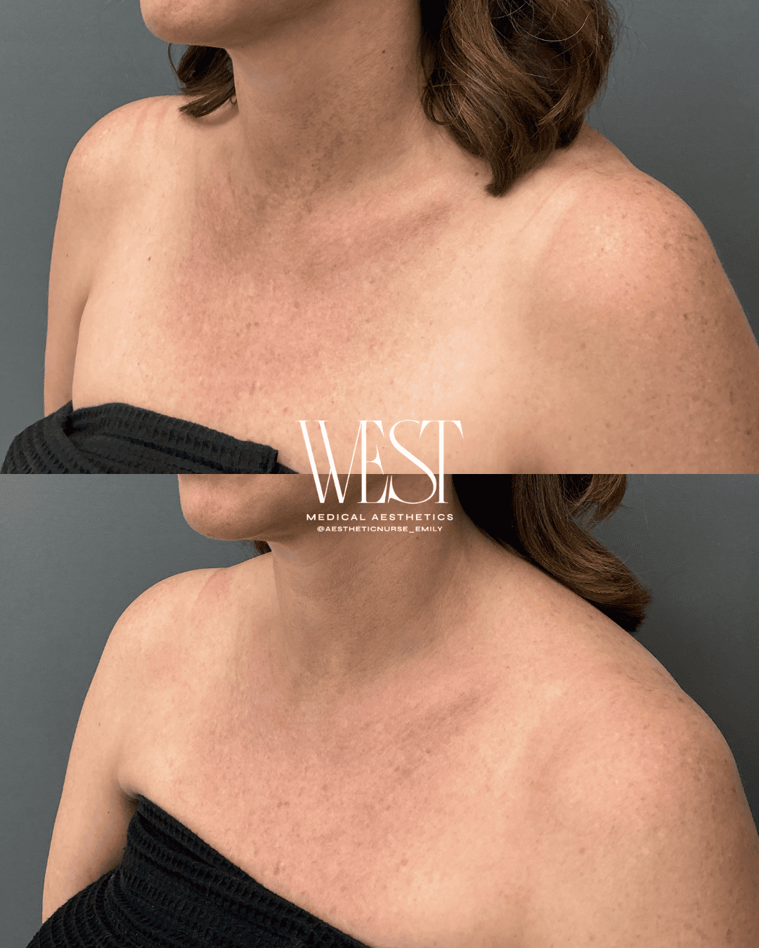 chest laser skin treatment okc