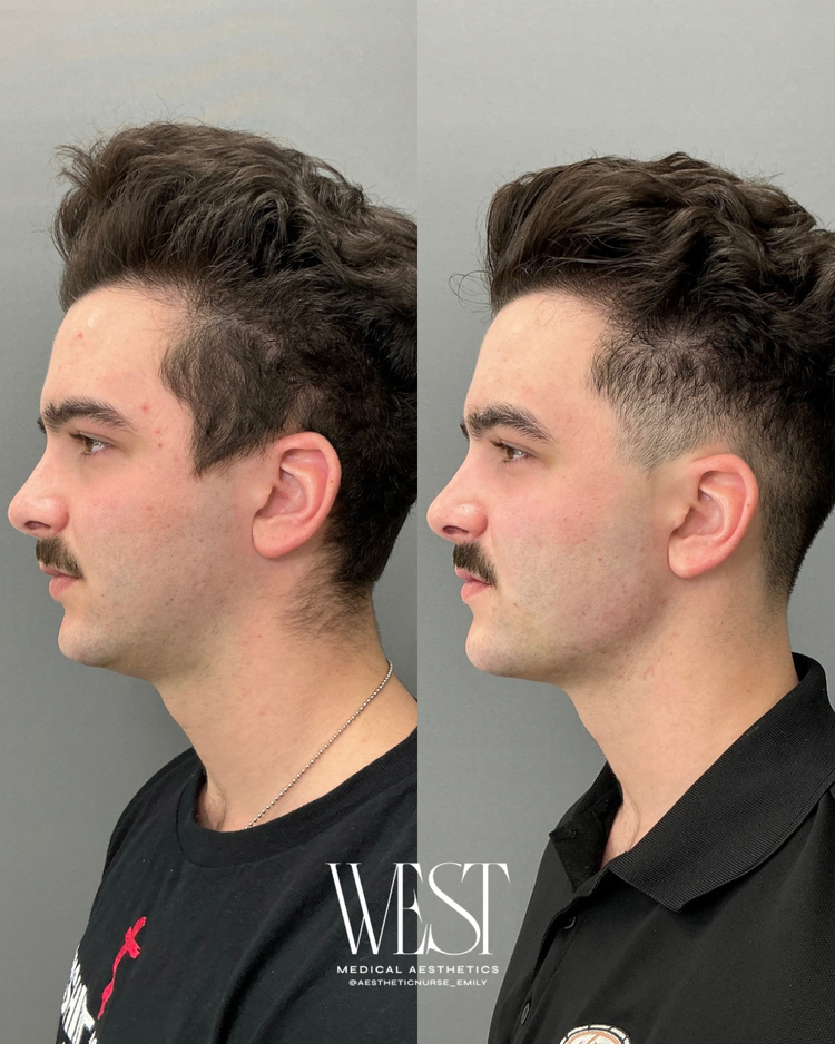 Jawline, Chin, Chin Shadow Filler