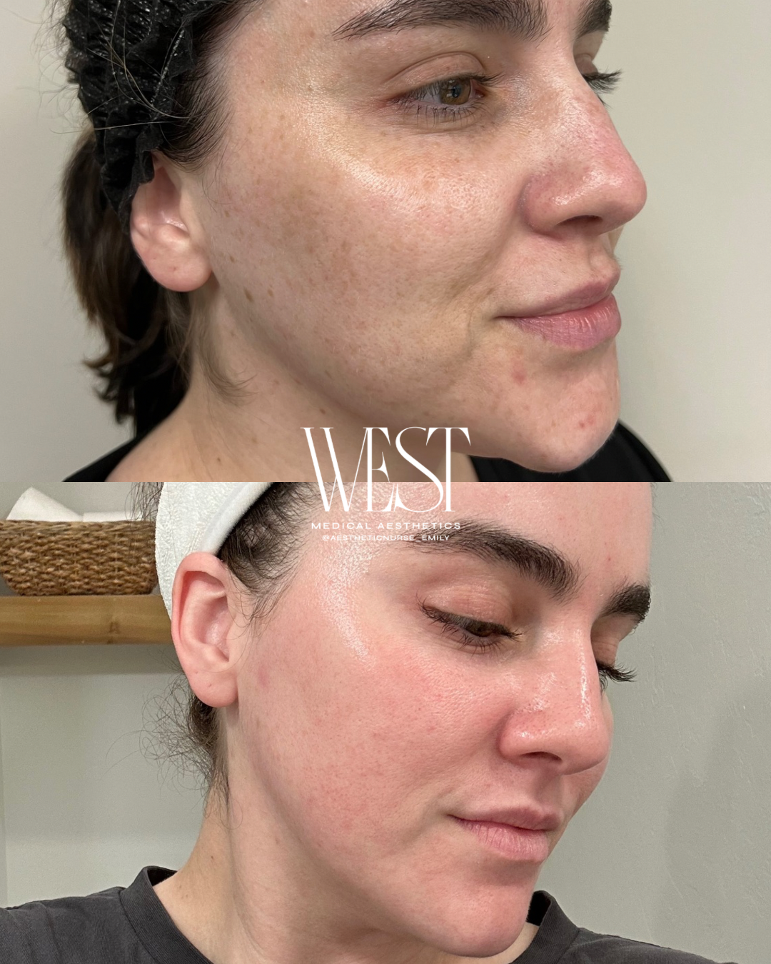 Laser skin treatment in okc