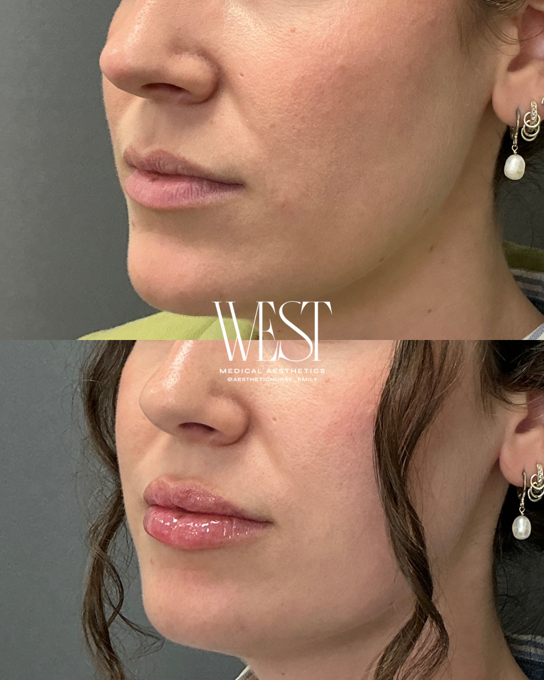 Top Lip Filler in Oklahoma City