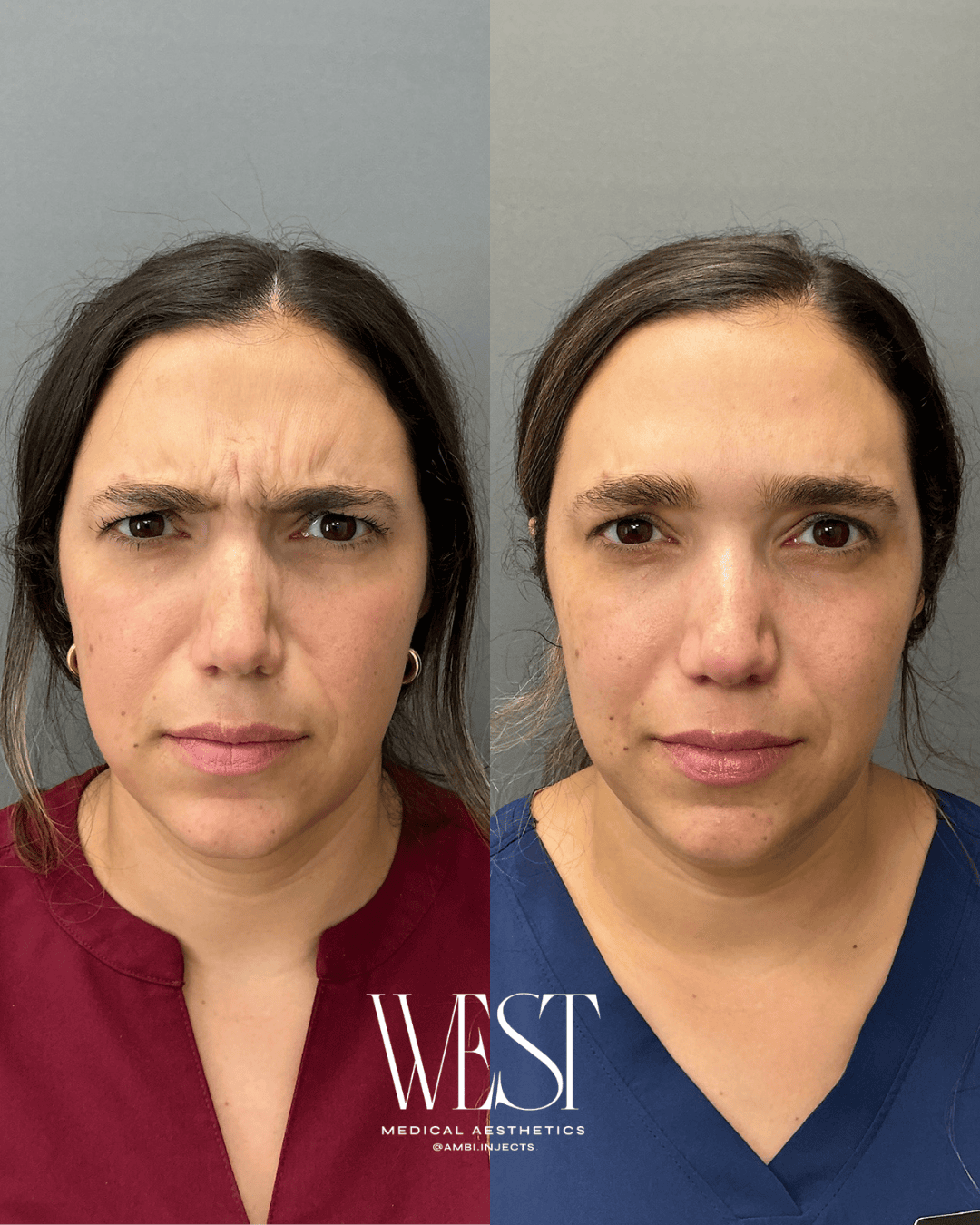 Dysport injectable in okc