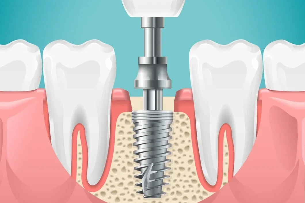 Why Dental Implants Are Important: Restoring Your Smile, Health, and Confidence