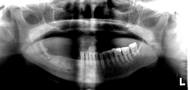Osteoporosis and Your Smile: What You Need to Know Before Your Next Dental Visit