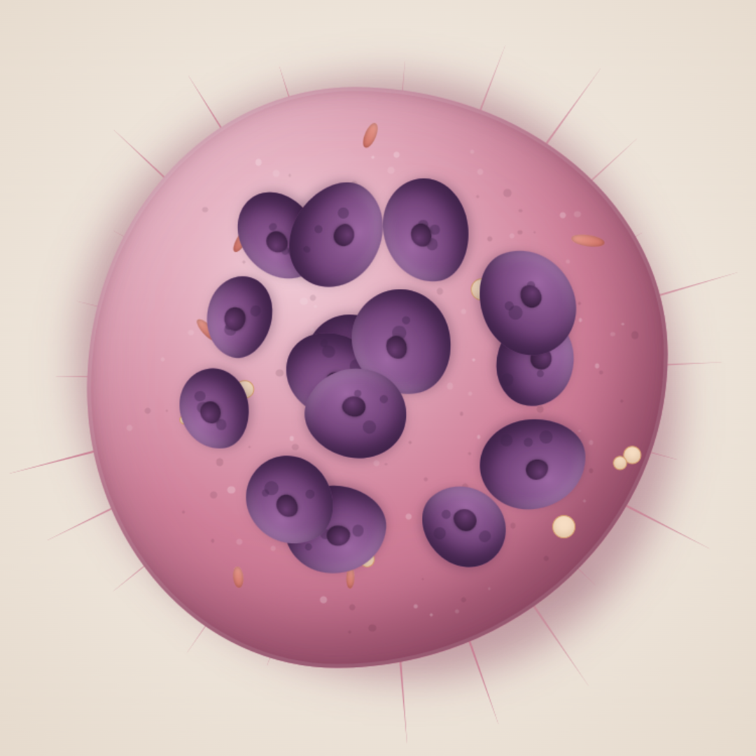 A new study identifies multinucleated giant macrophages as a hallmark of aggressive pancreatic cancer
