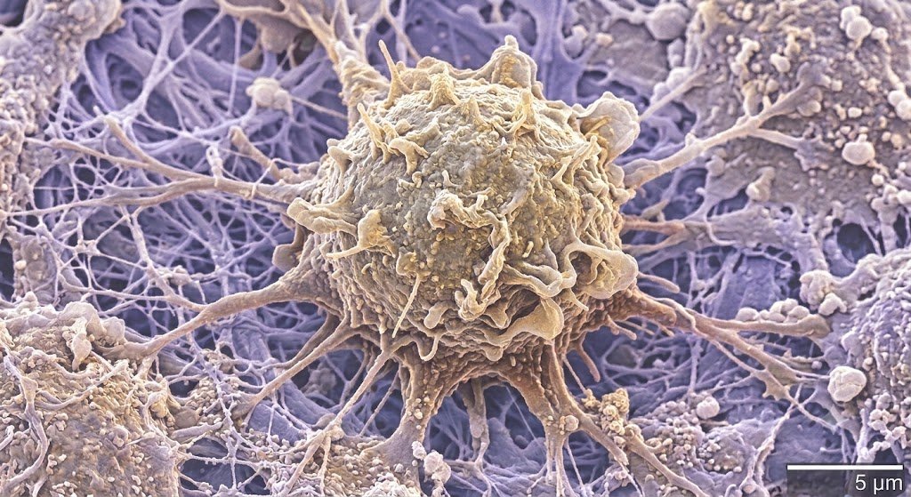 A Protein Called Fra-2 May Explain Why KRAS Inhibitors Stop Working in Pancreatic Cancer
