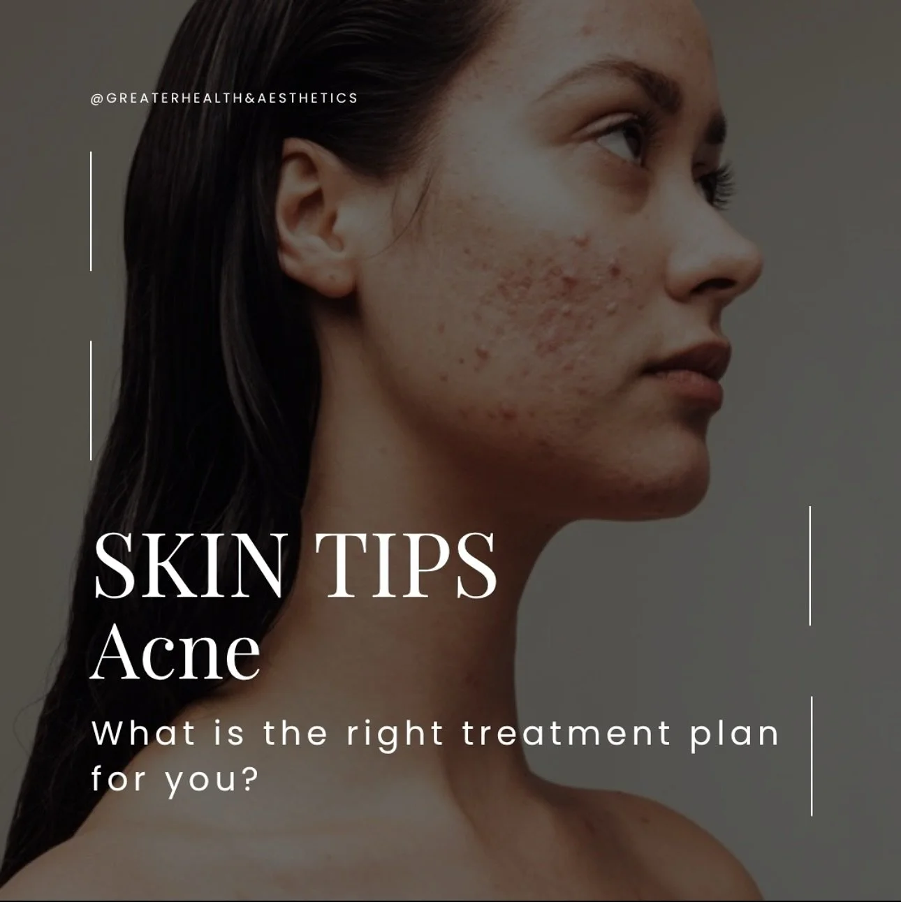Acne requires more than a one-step solution&mdash;it deserves a full-circle approach.
From in-office collagen stimulation to at-home LED care, we combine innovation from CosmoFrance, HealMD, NovaThreads, and RajaniMD to treat breakouts, rebuild skin 
