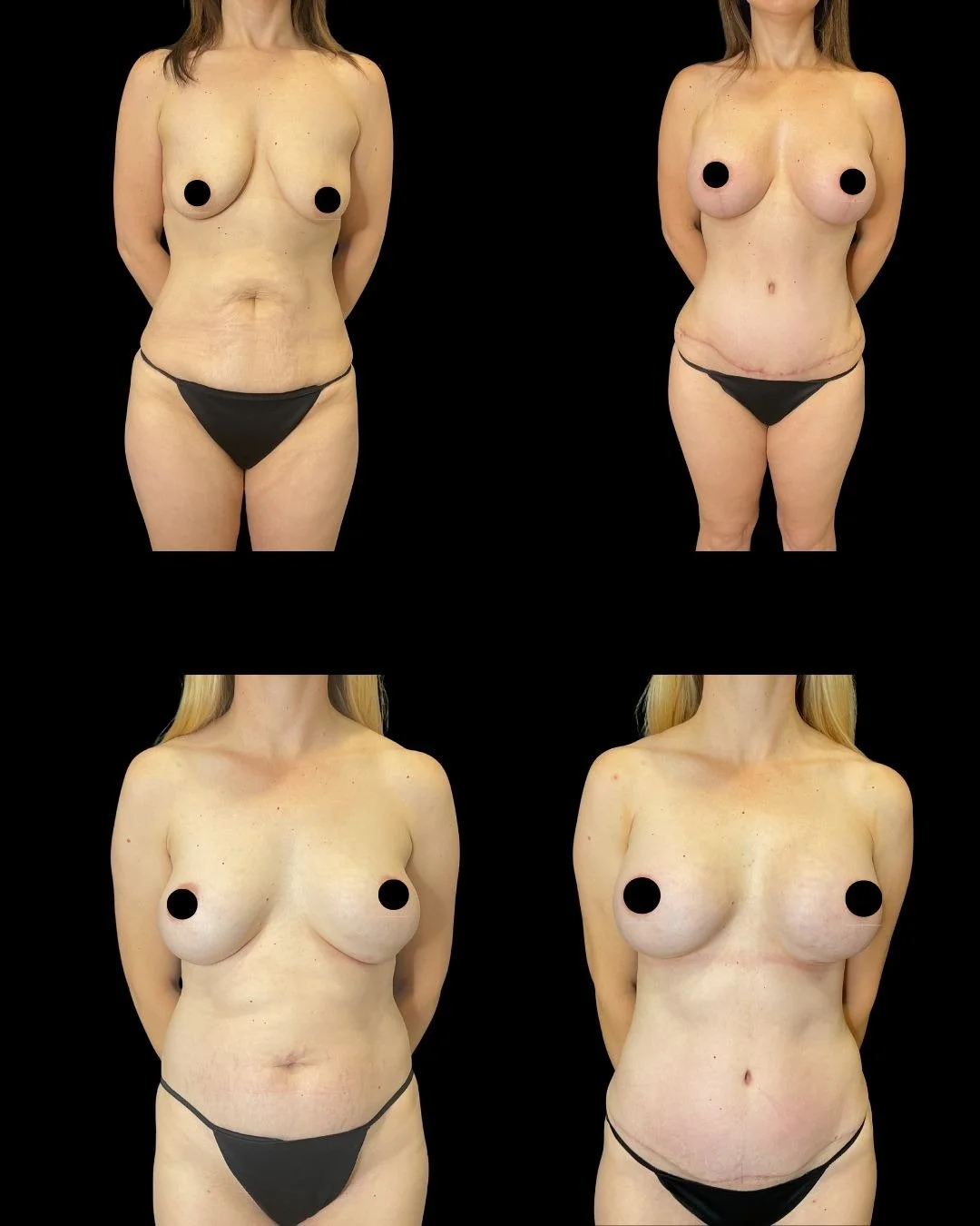 Mommy makeover before and after results in Utah County