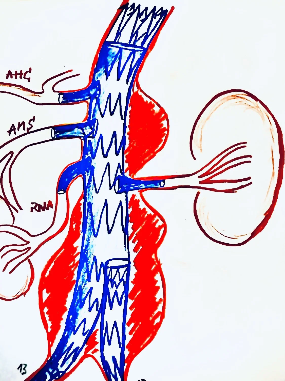FEVAR Thoracoabdominal aortic aneurysm aortic surgery Philipp T. Ghibu