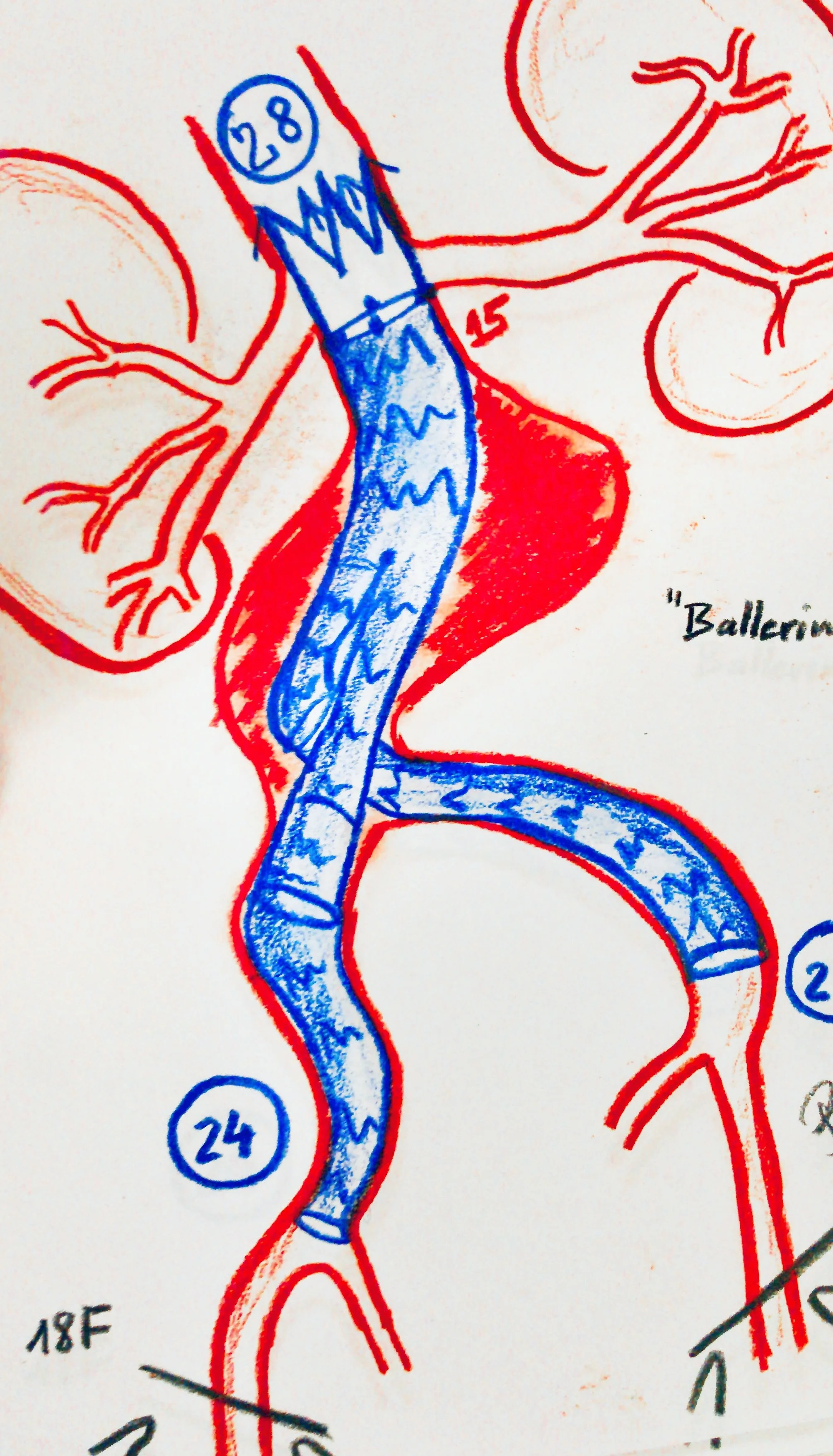 Standard Percutaneous EVAR Ballerina Aortic Aneurysm