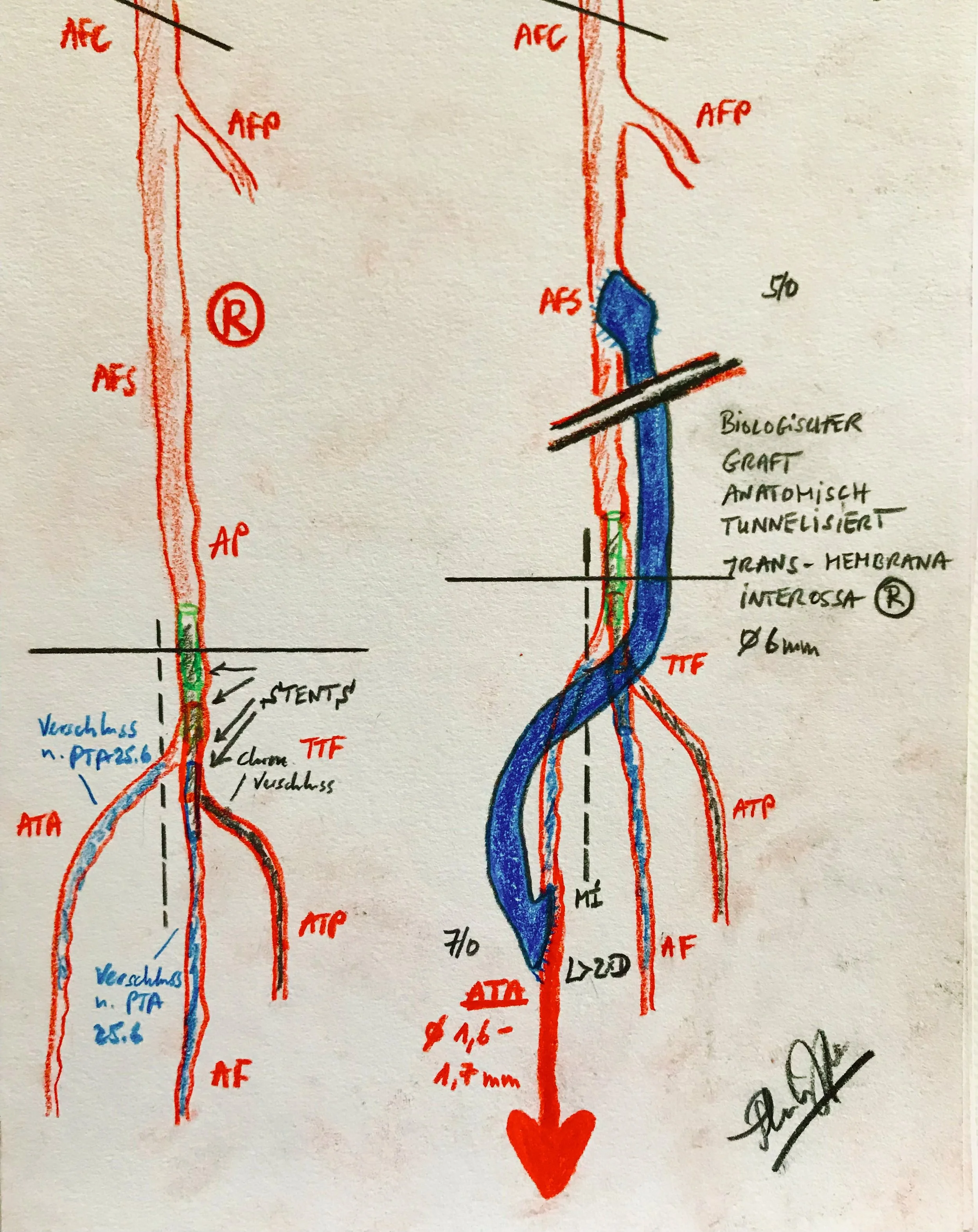 to Bypass or not to bypass?