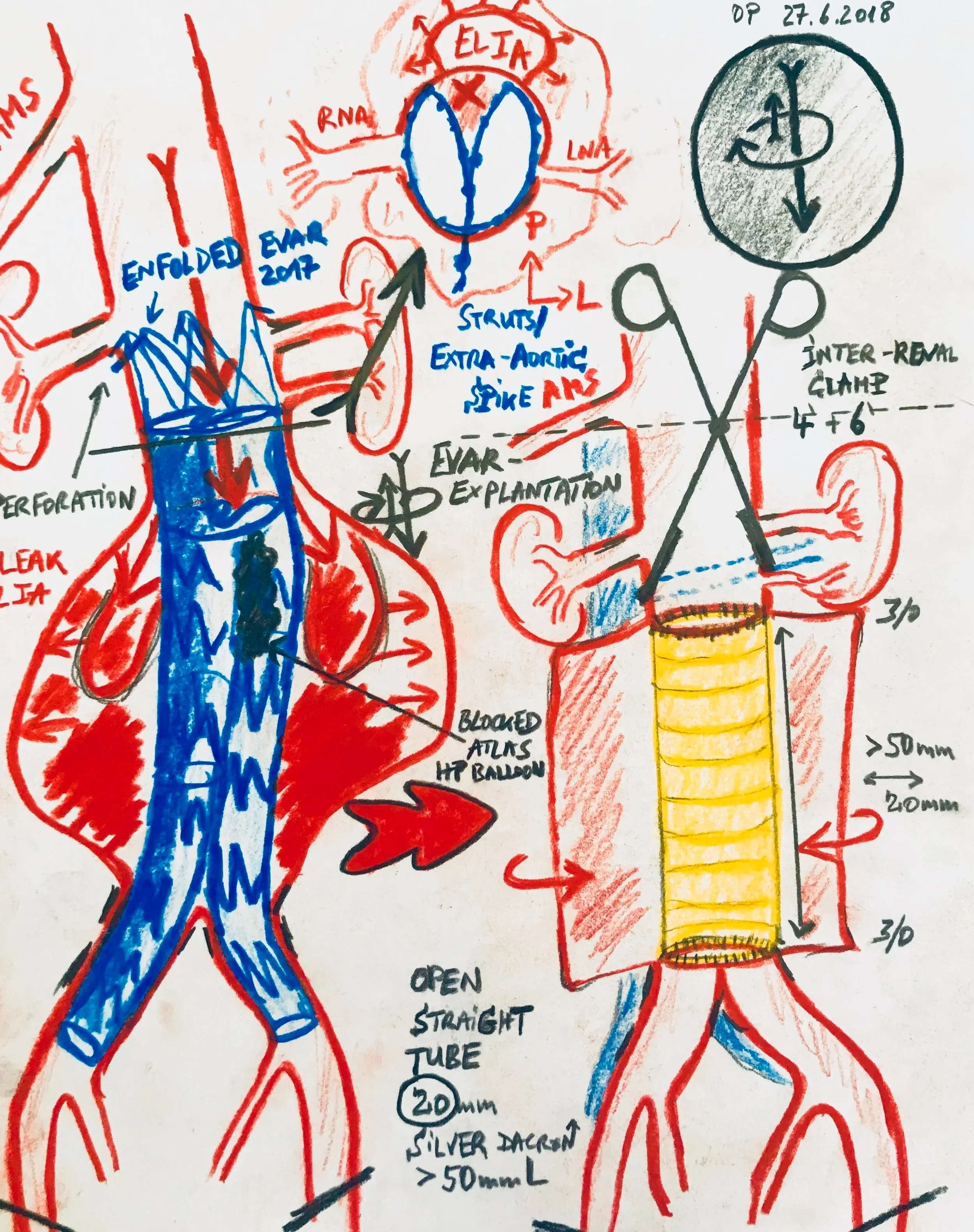 EVAR-Explantation and open conversion (Stentgraft Enfold with type I endoleak)