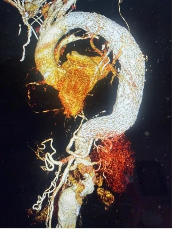 Aortenchirurgie in zwei Schritten
