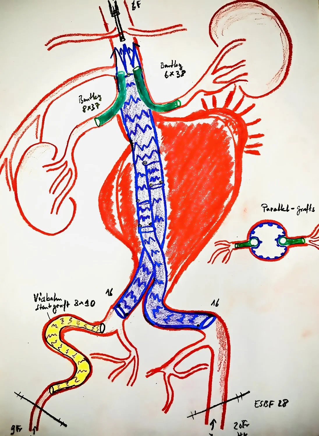 Emergency Aortic Repair CH-EVAR  2- Parallel-Grafts  for ruptured aortic aneurysm