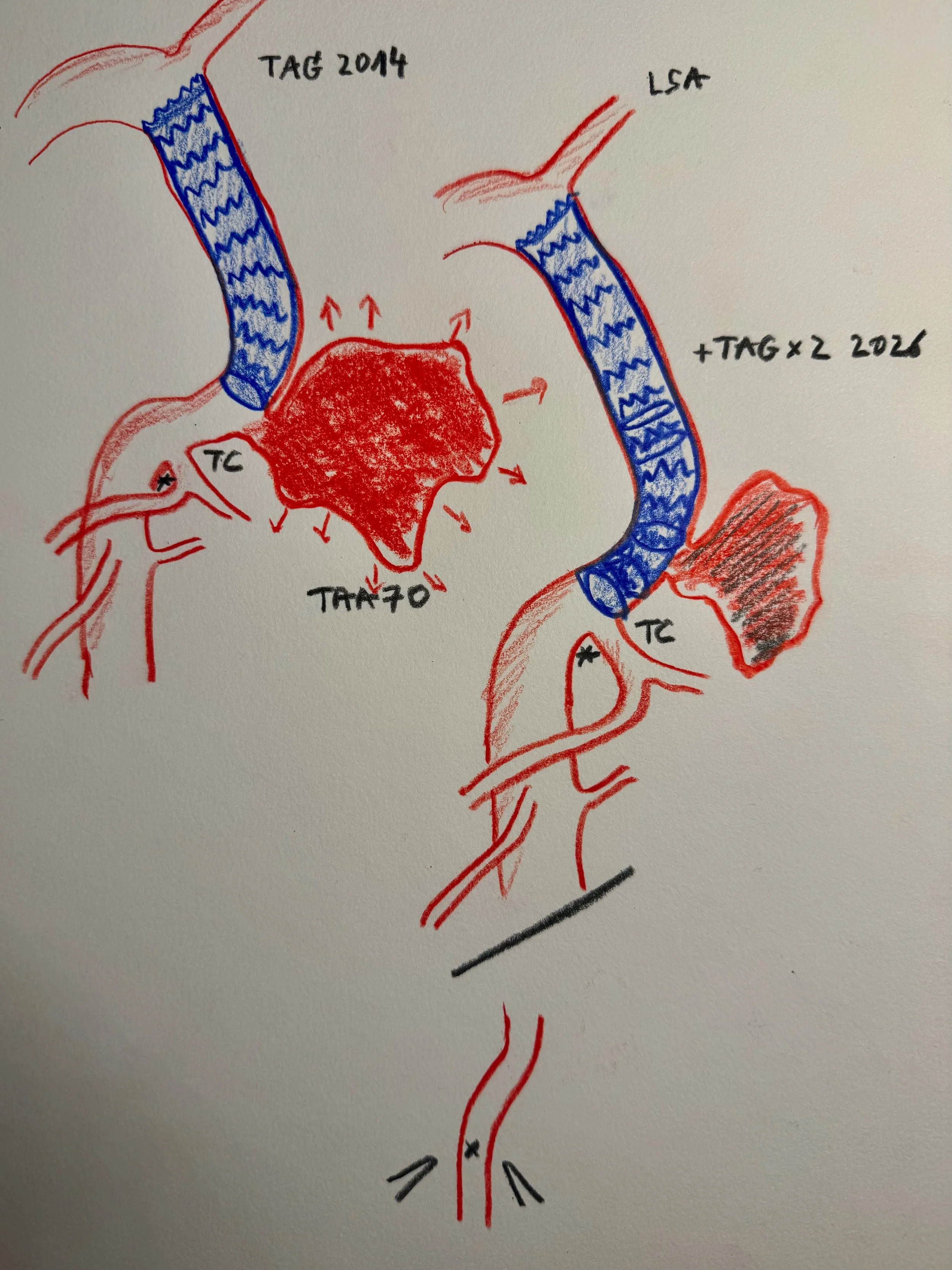 TEVAR Redo for Thoracic Aortic Aneurysm