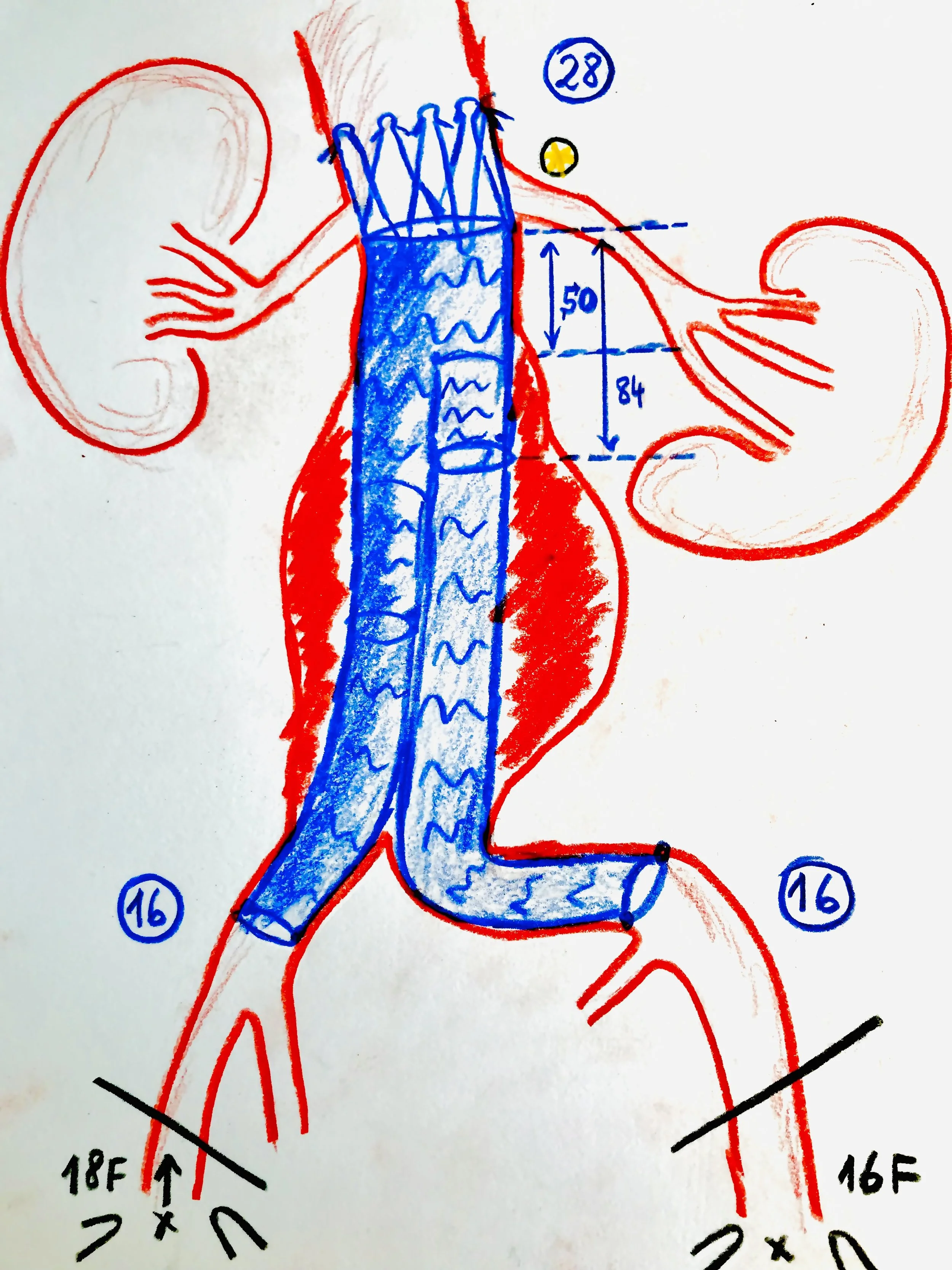 Standard Endovascular Aortic Repair EVAR