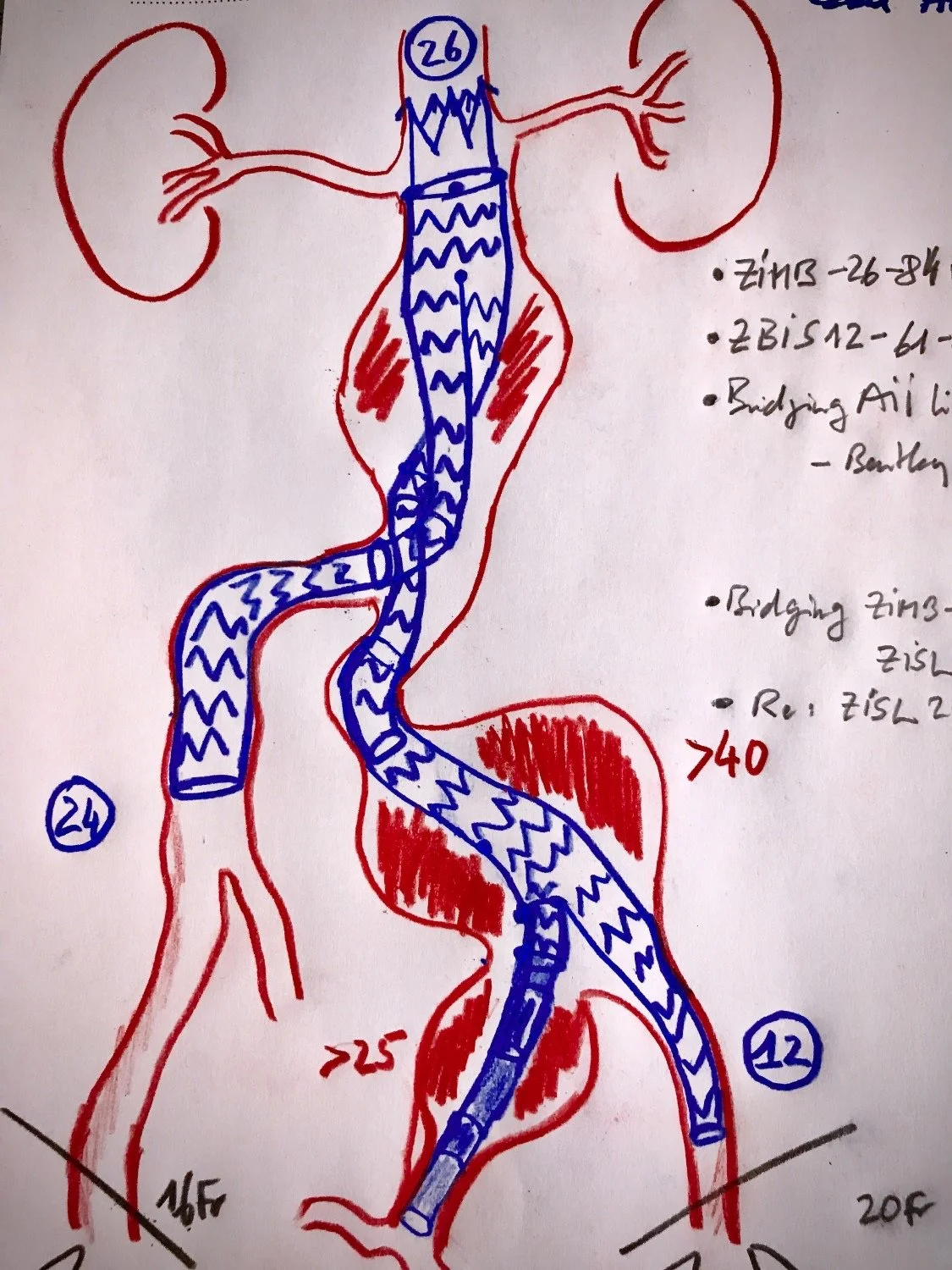 percutaneous EVAR  + Iliac Branched Device for Aorto-iliac aneurysm repair 