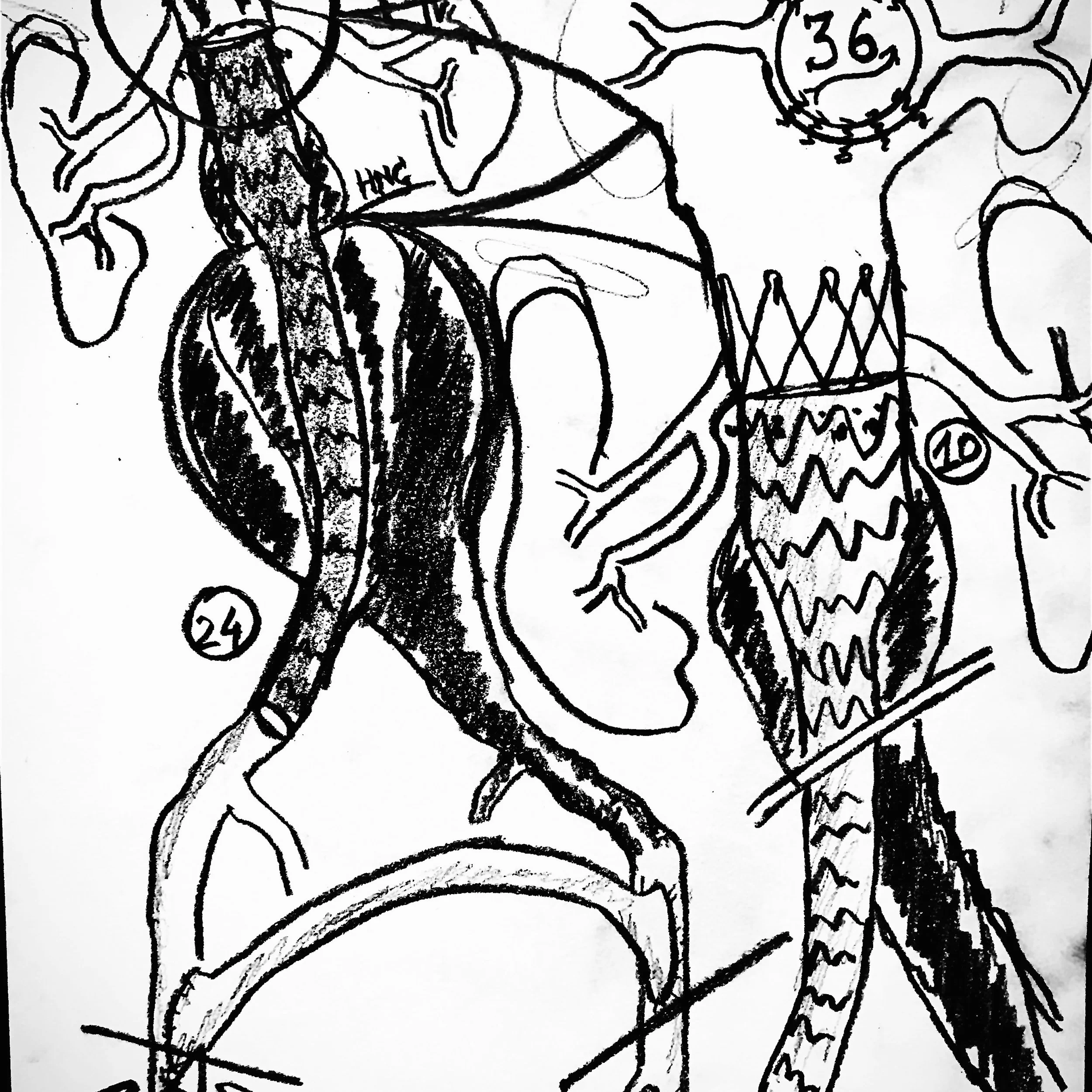 AUI - EVAR Crossover bypass graft 