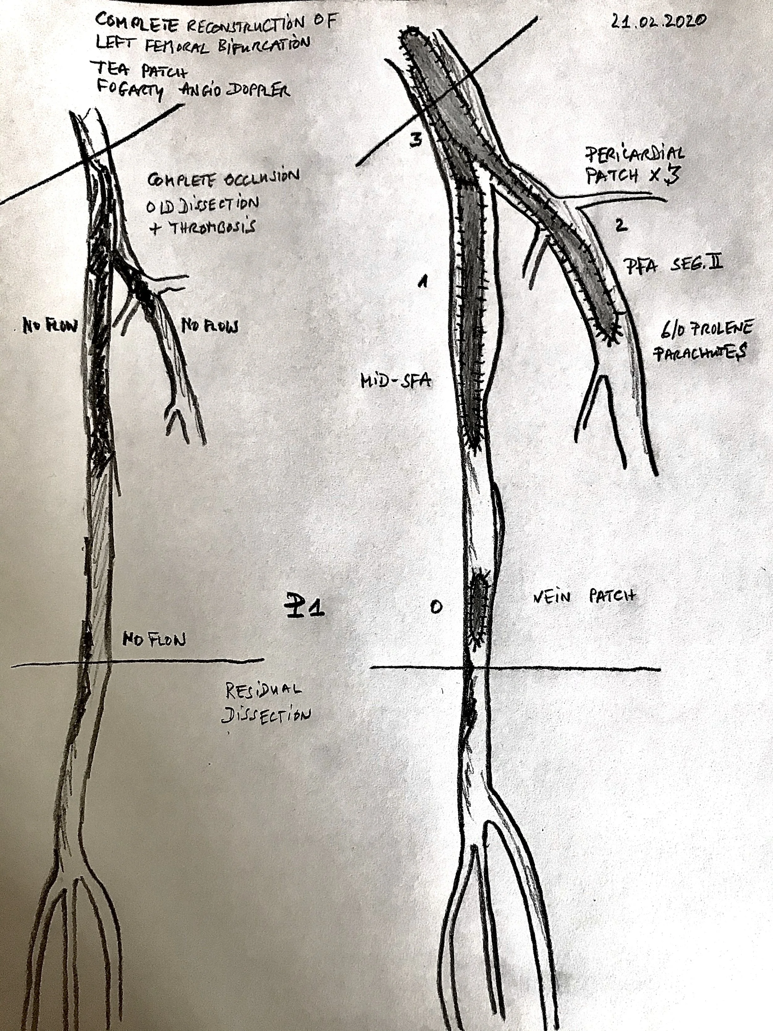 Reconstruction of the femoral bifurcation (patch plasty) Fogarty Thrombectomy OTW 
