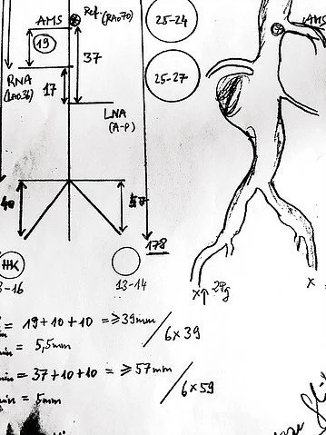 Planning-Sizing Komplexe Endoprothese EVAR FEVAR Aortenaneurysma