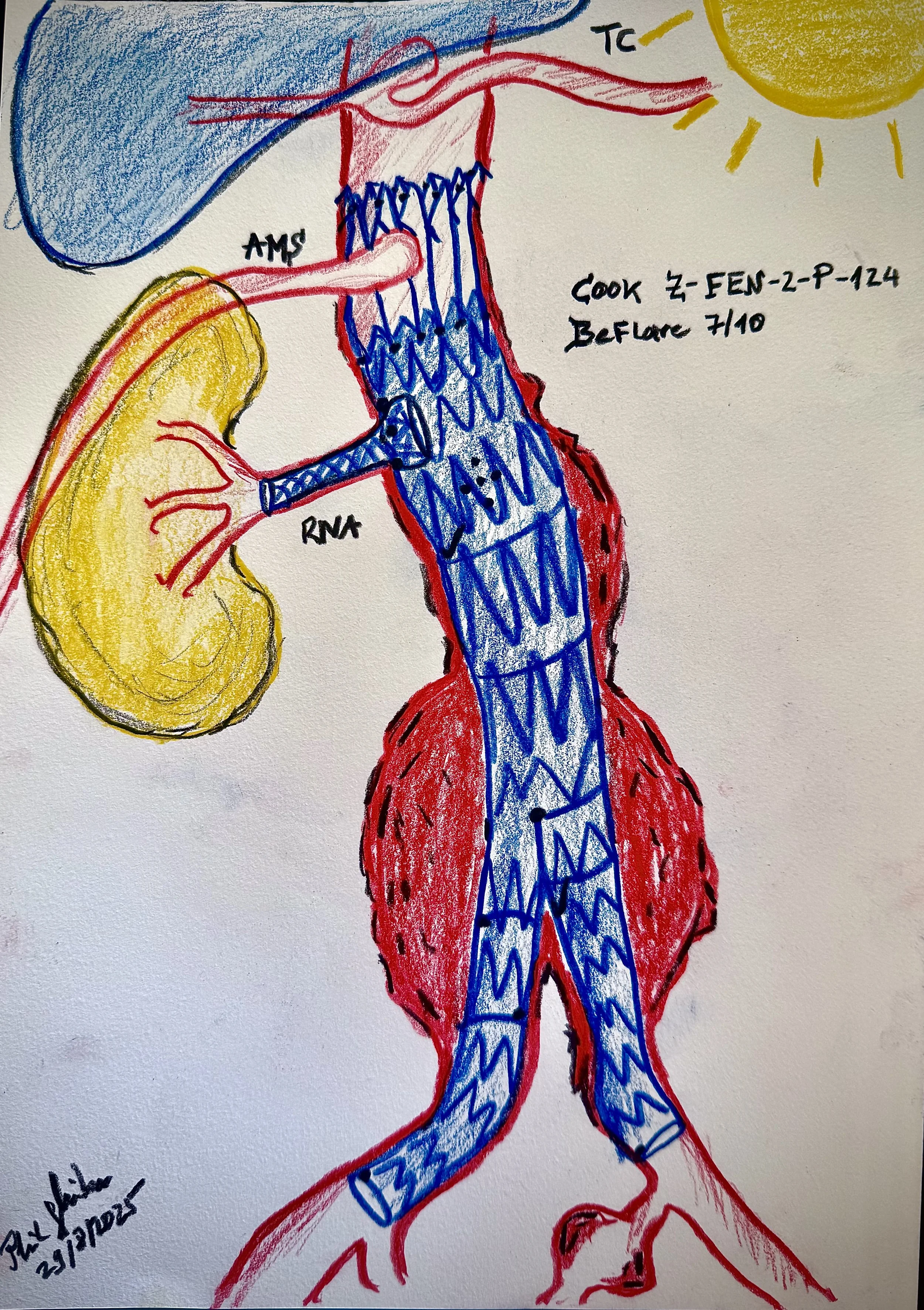 Percutaneous FEVAR for junta-renal aortic aneurysm repair