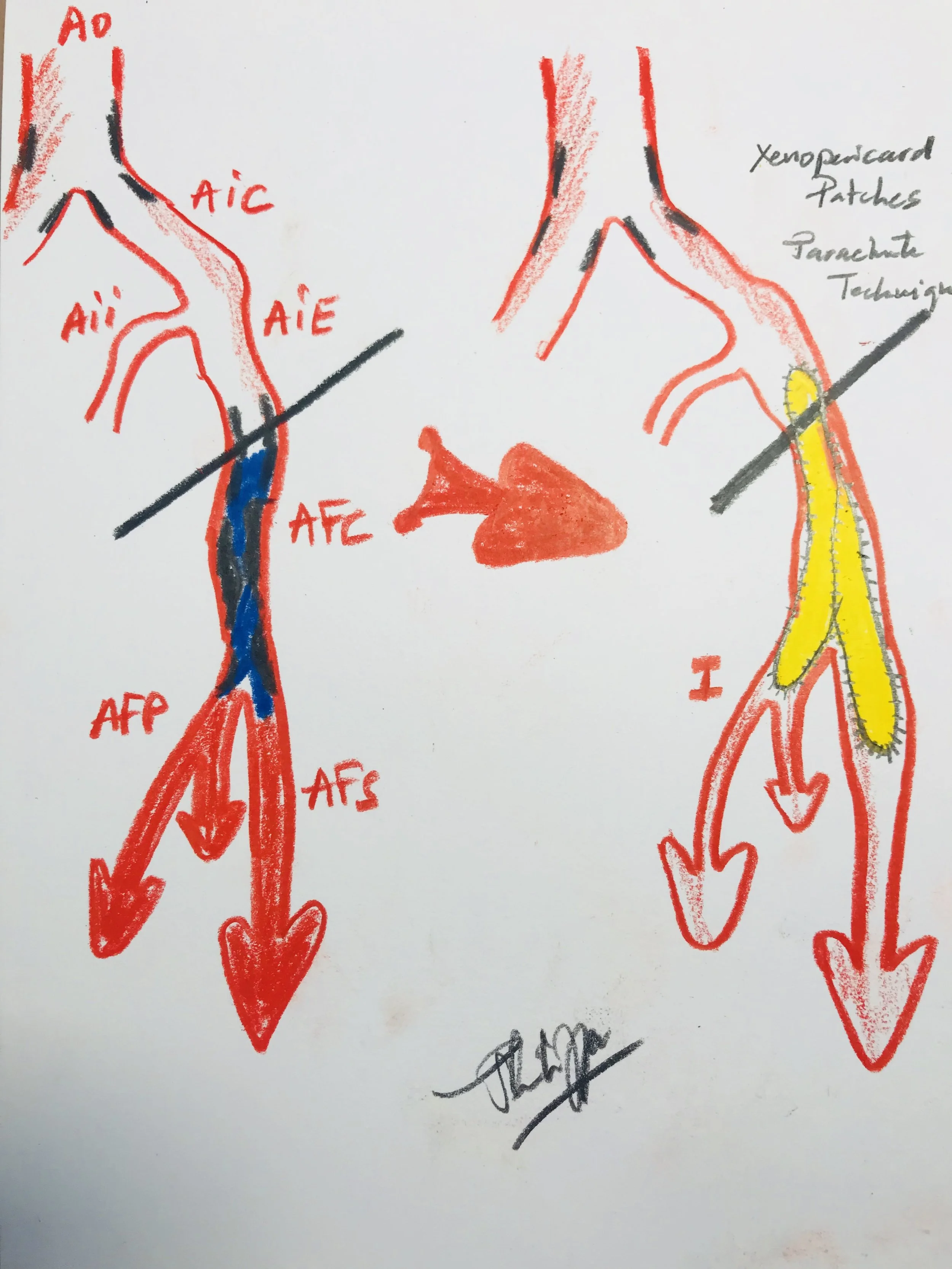 Common iliofemoral Repair (Xenopericardial Patch plasty)