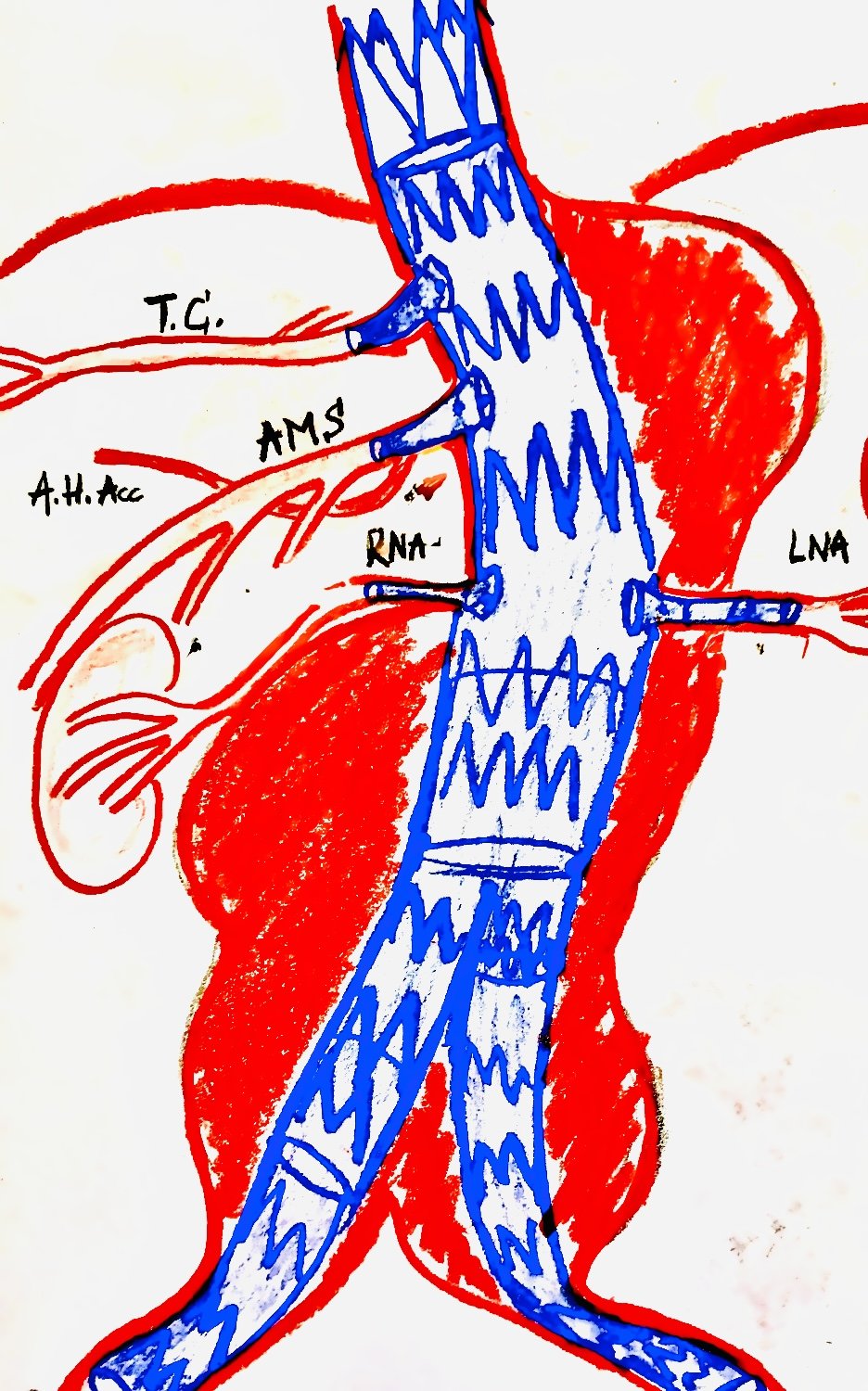 fenestrated EVAR thoracoabdominal aortic aneurysm Zurich specialist