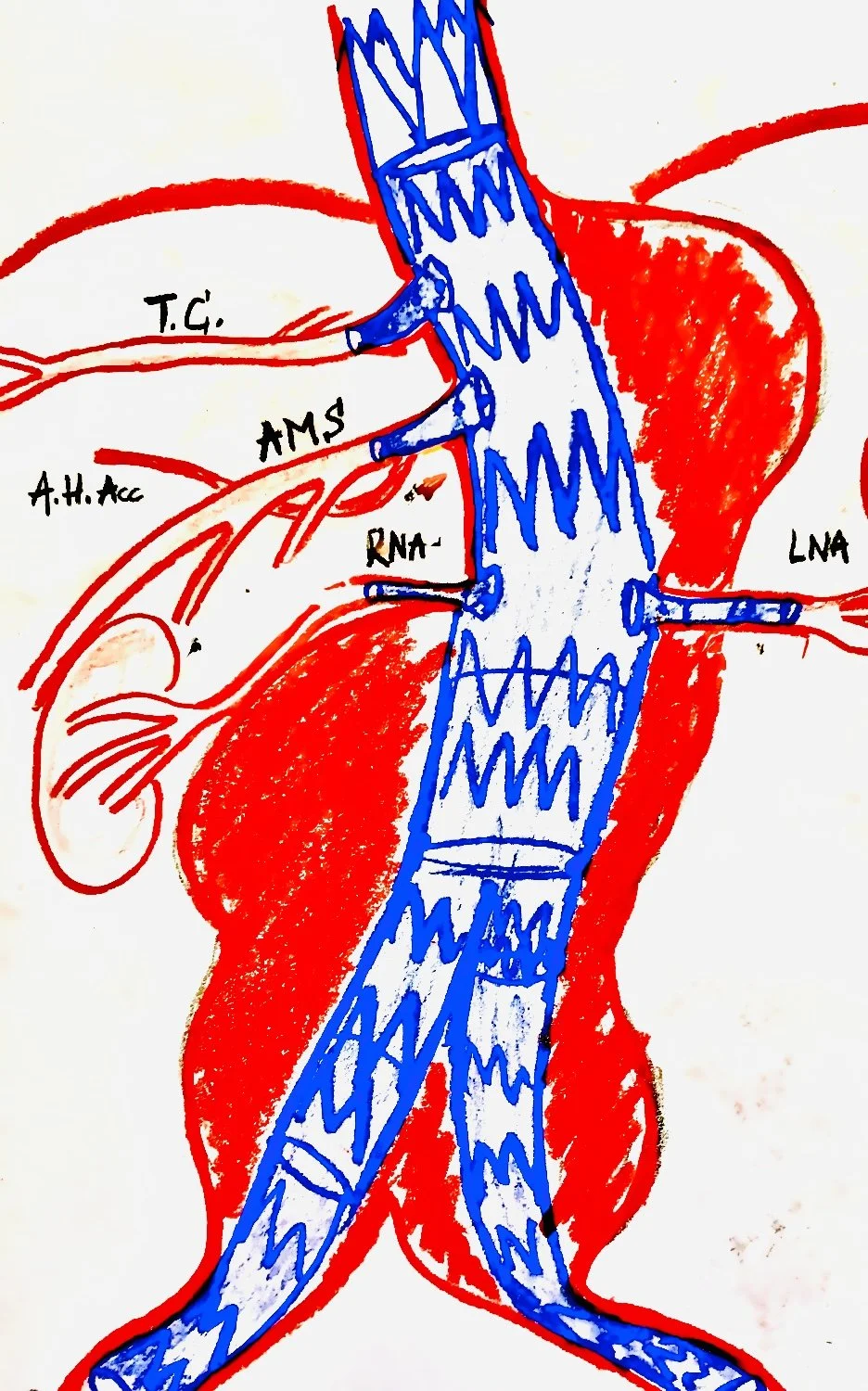 4-Fen FEVAR Custom Made Device for thoracoabdominal Aortic Aneurysm (Percutaneous) Crawford IV Dr. Philipp T. Ghibu