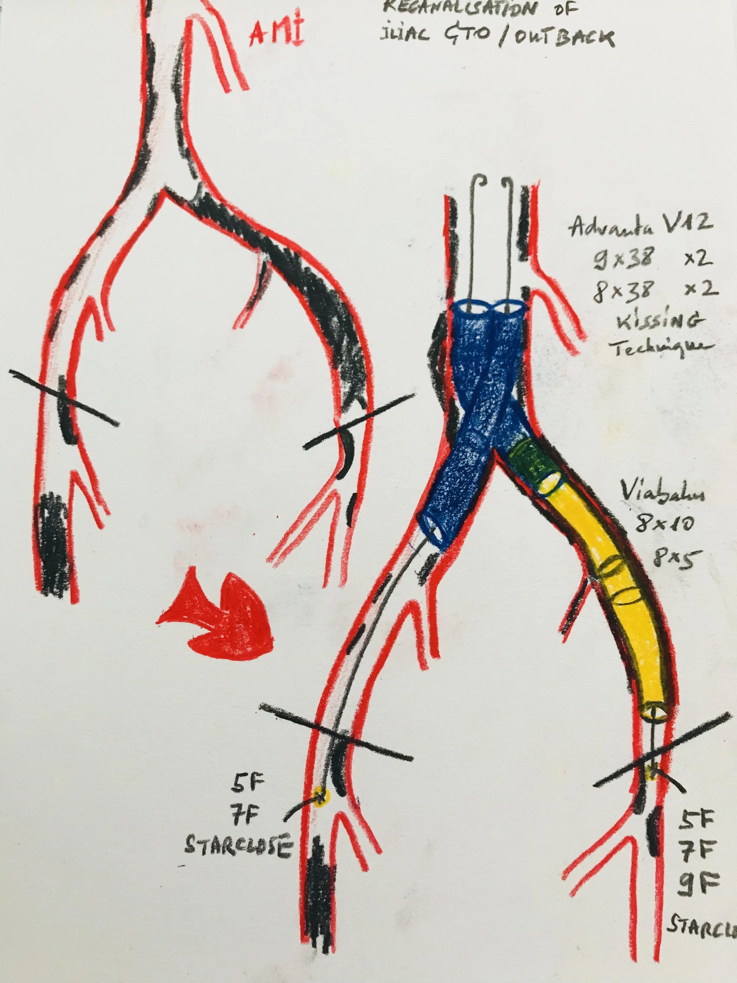 Covered Endovascular Reconstruction of the Aortic Bifurcation CERAB (percutaneous)