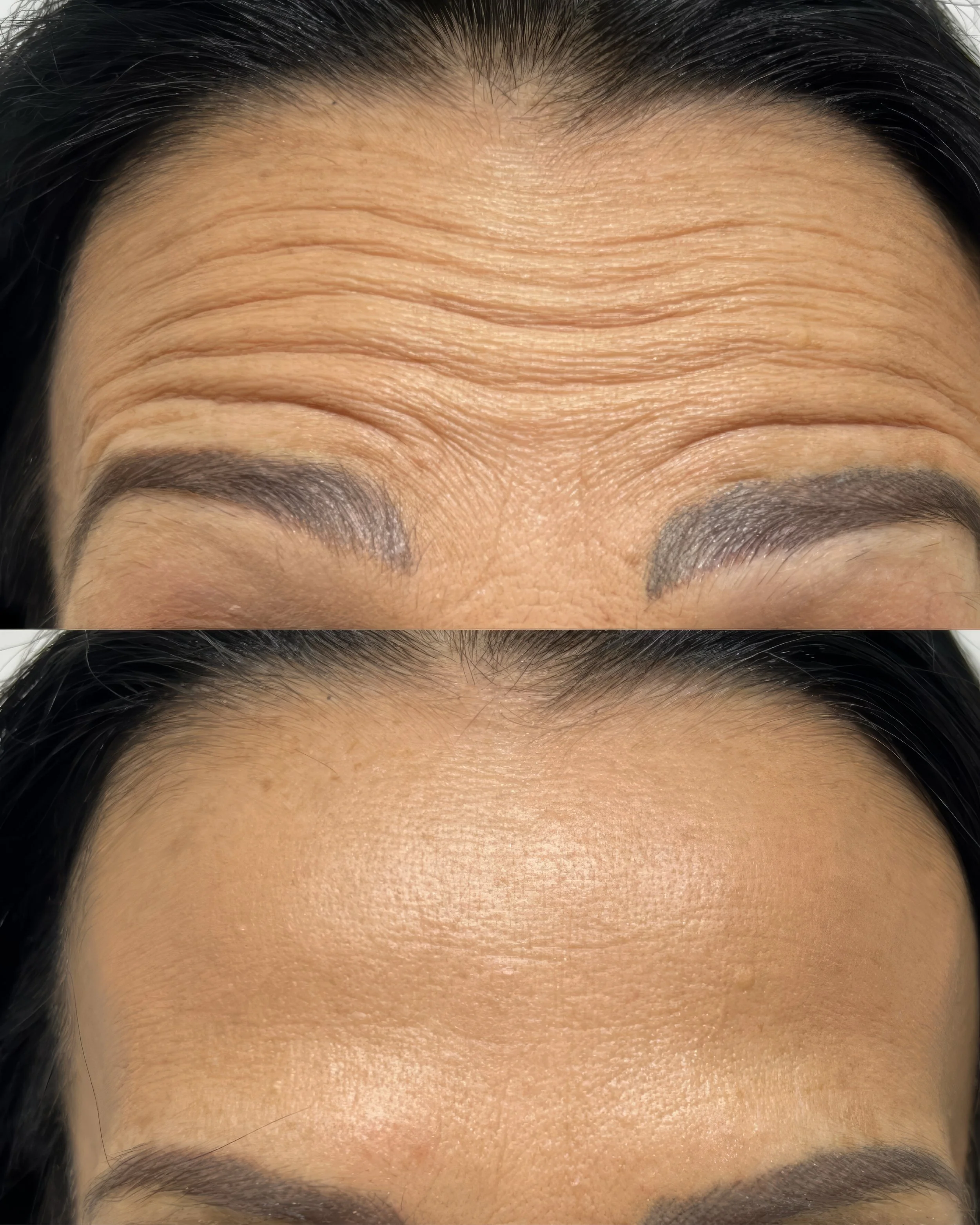 Copy of BOTOX AND FILLER BEFORE&AFTER.jpg.JPG