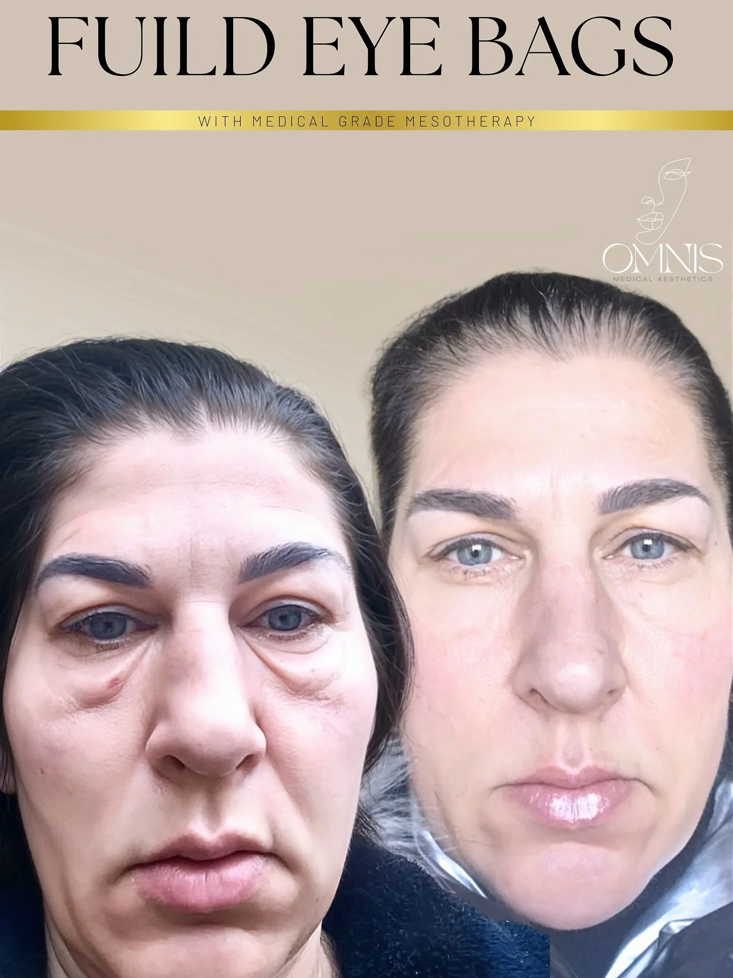 🫶🏼

This amazing transformation was achieved with a course of 3 medical-grade mesotherapy treatments, designed to reduce under eye puffiness , fluid filled eye bags and improve skin quality.

Consistency and a personalised treatment plan are key to
