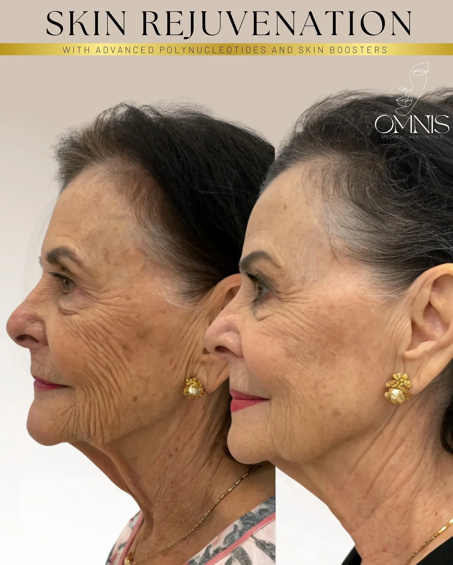 For those who know me, you know I love the science behind the art of aesthetics.
 Transformation isn&rsquo;t about changing a face, it&rsquo;s about understanding how the skin functions, heals, and regenerates.

When you combine advanced polynucleoti