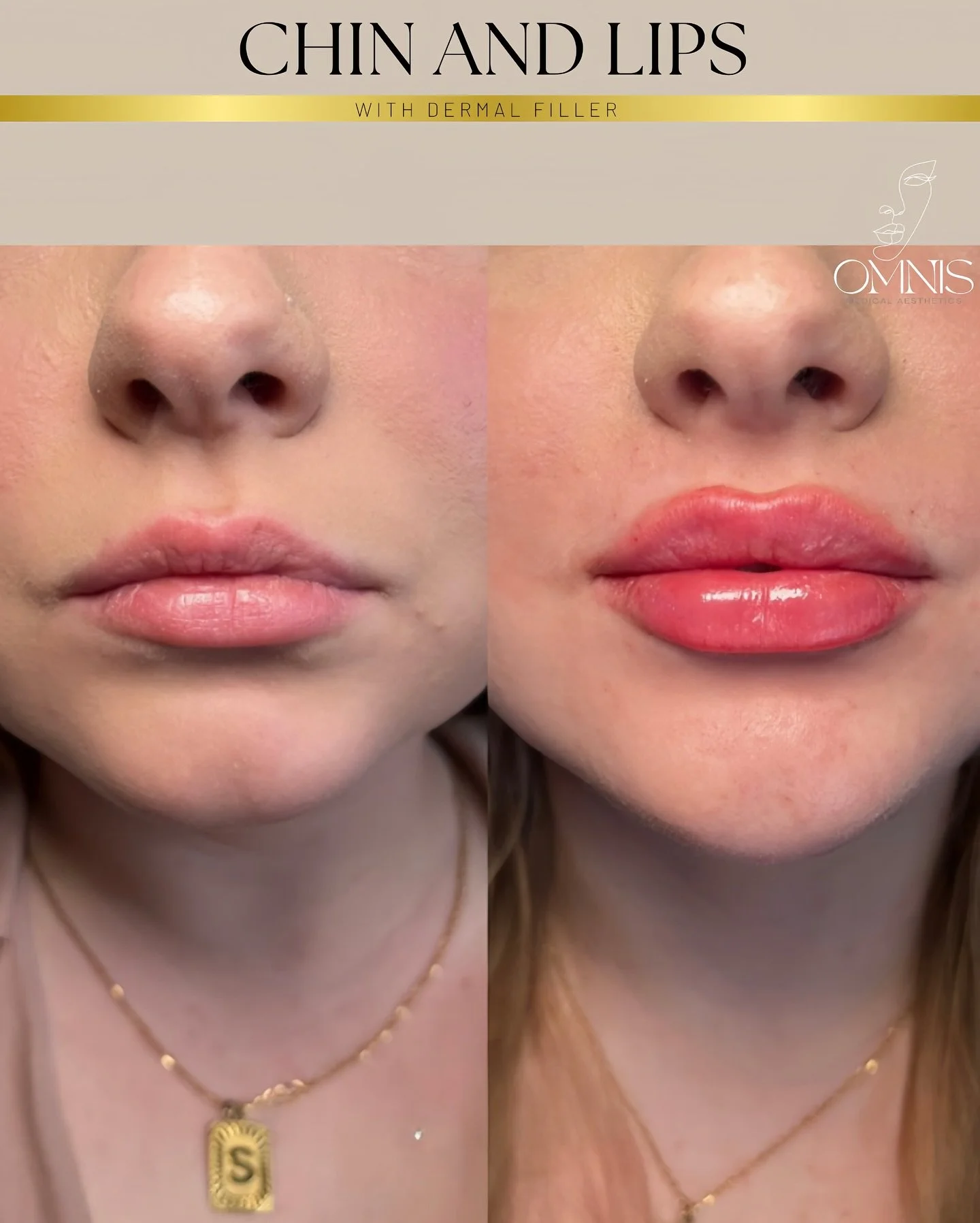 ▪️Chin &amp; Lip Enhancement▪️
Subtle definition and balance created using dermal filler enhancing natural proportions while maintaining a soft, feminine contour 💋

#OMNISMedicalAesthetics #DermalFiller #LipFiller #ChinFiller #FacialBalancing #Natur