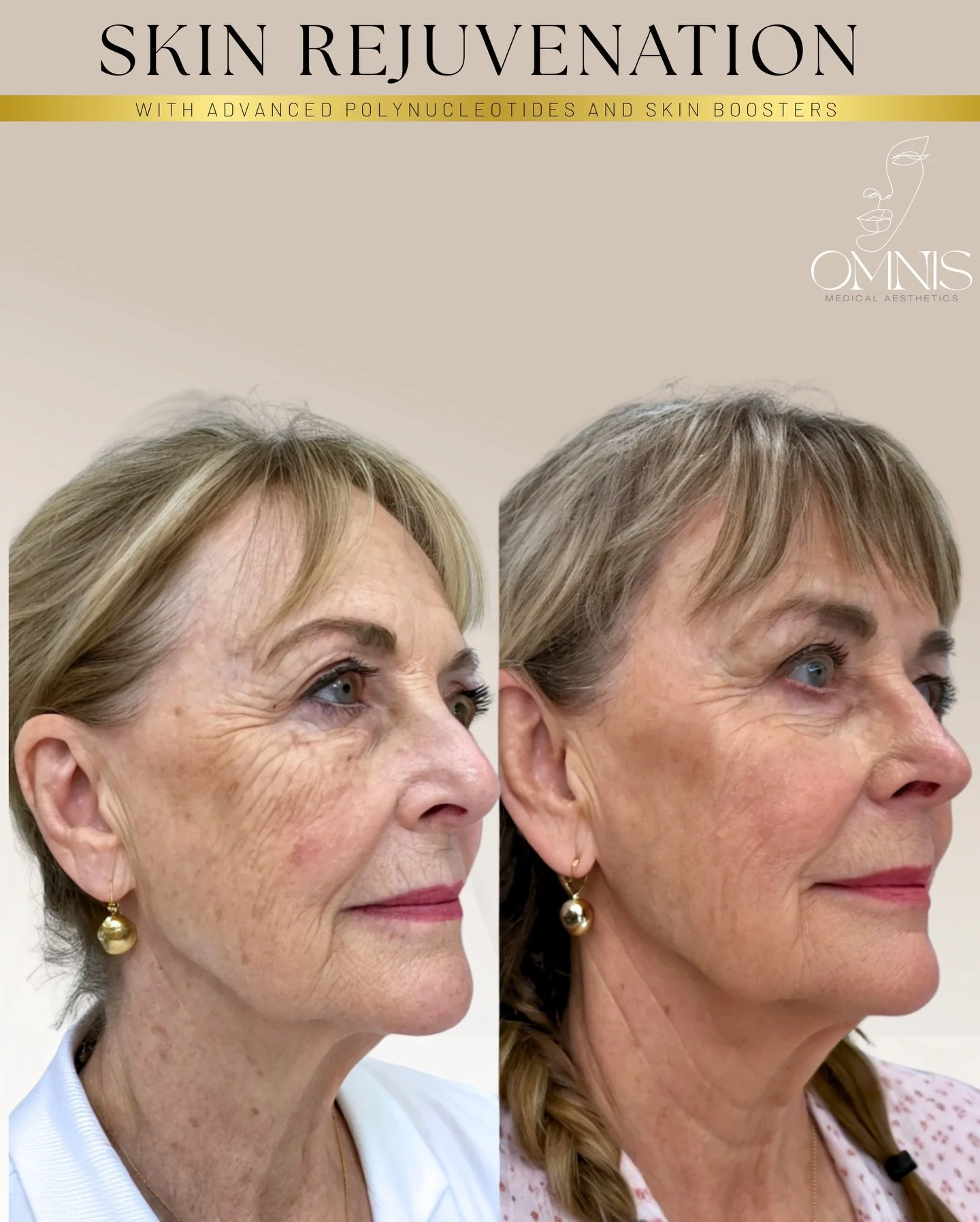 Not everyone wants dermal fillers or anti-wrinkle treatment (botulinum toxin) 💉
&hellip;and that&rsquo;s completely okay.

This beautiful transformation was achieved using advanced polynucleotides + skin boosters only &ndash; no filler in the cheeks