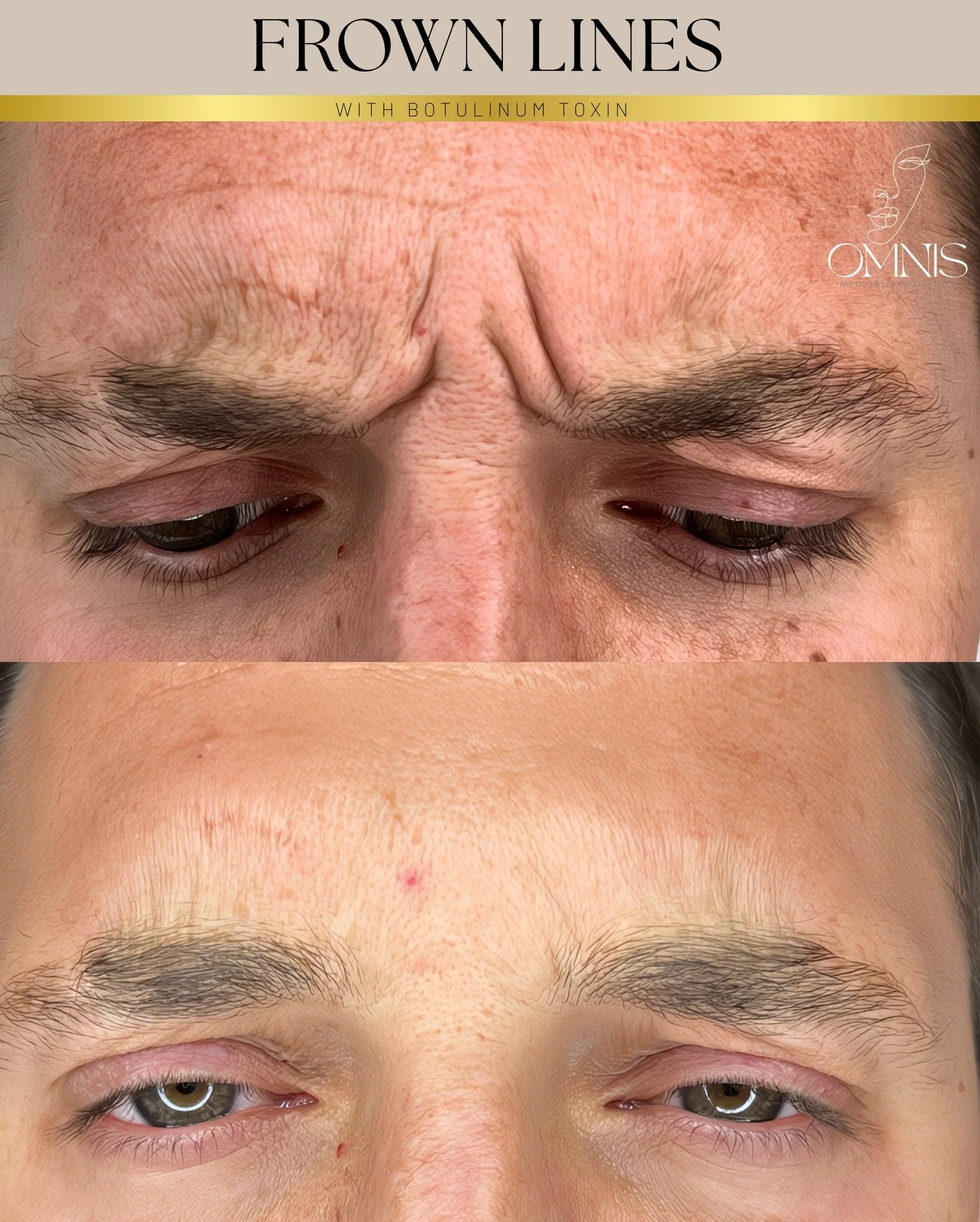 ▪️Anti-wrinkle treatment isn&rsquo;t &ldquo;just for women&rdquo; 💬

Lines from frowning, concentrating or years of hard work show up on every face &ndash; male and female and choosing to soften them does not make you any less manly.

Anti-wrinkle t