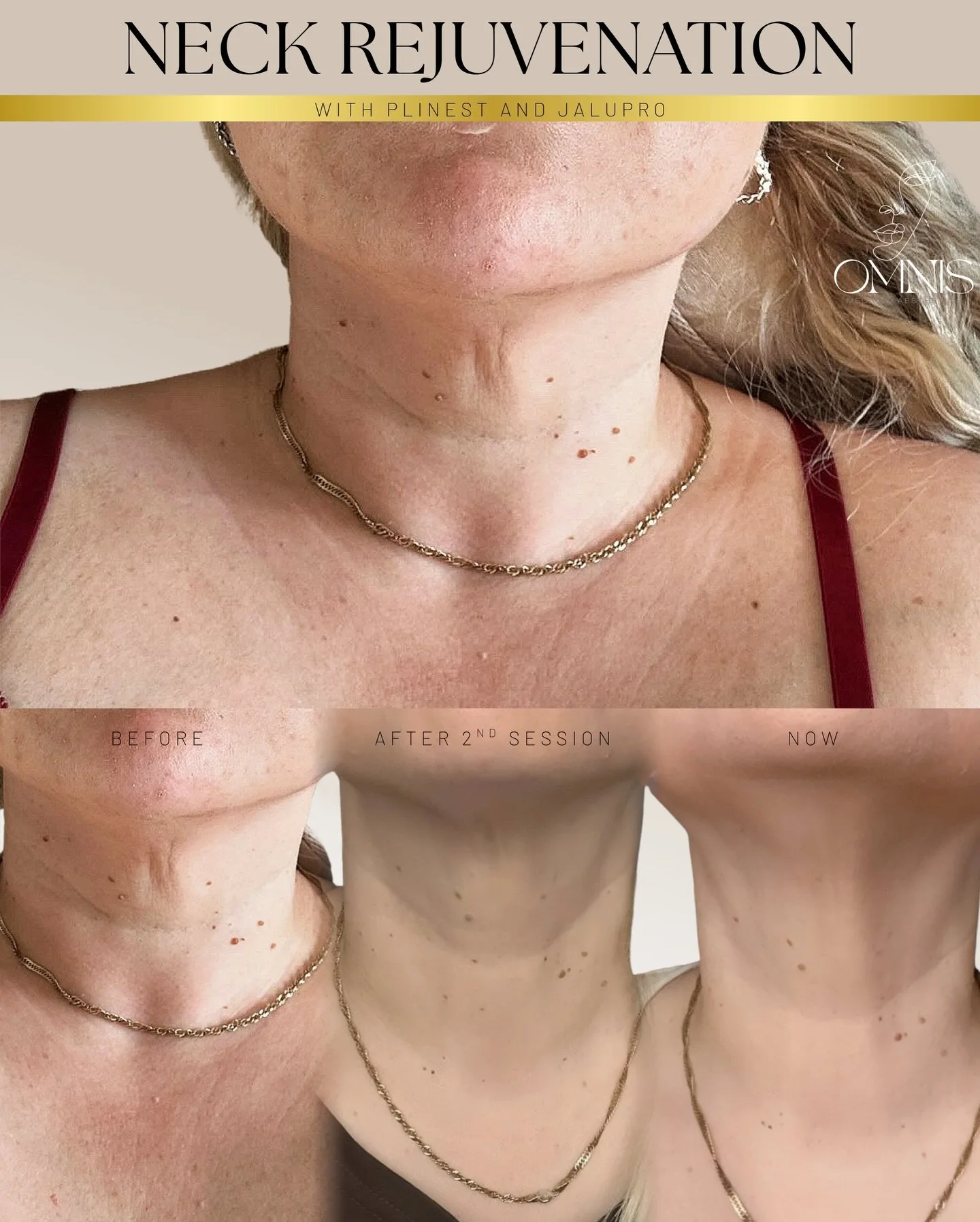 ▪️▪️▪️Neck Rejuvenation ▪️▪️▪️

The neck often reveals signs of ageing before the face; fine lines, crepiness, and loss of skin quality can appear gradually over time.

This result showcases progressive skin regeneration and tightening using a target