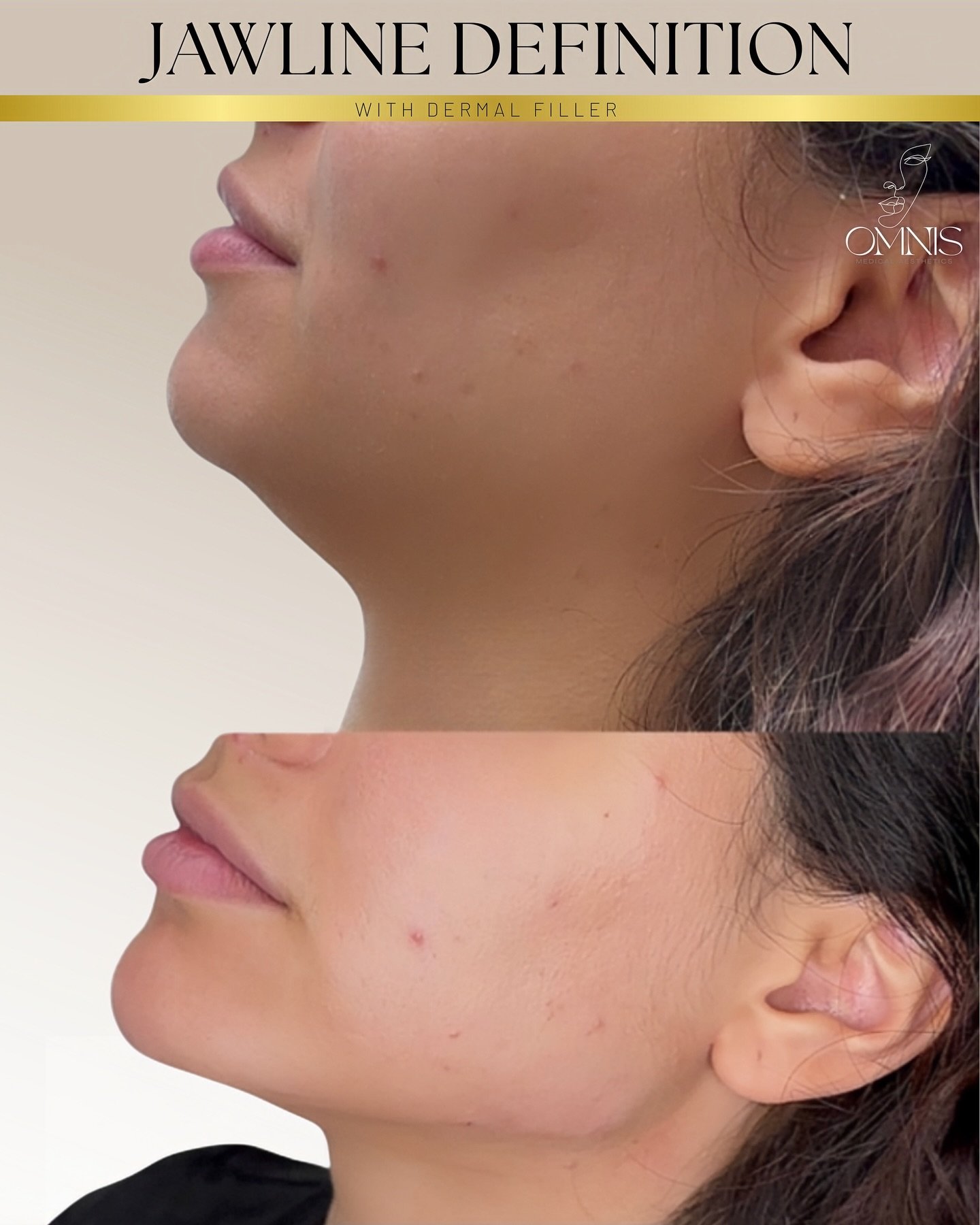 This is what jawline definition really does ⬇️

It doesn&rsquo;t just sharpen the jaw.
It rebalances the entire facial profile.

▪️Stronger structure
▪️Cleaner side profile
▪️More defined lower face
▪️Instant harmony

One subtle treatment &mdash; a c