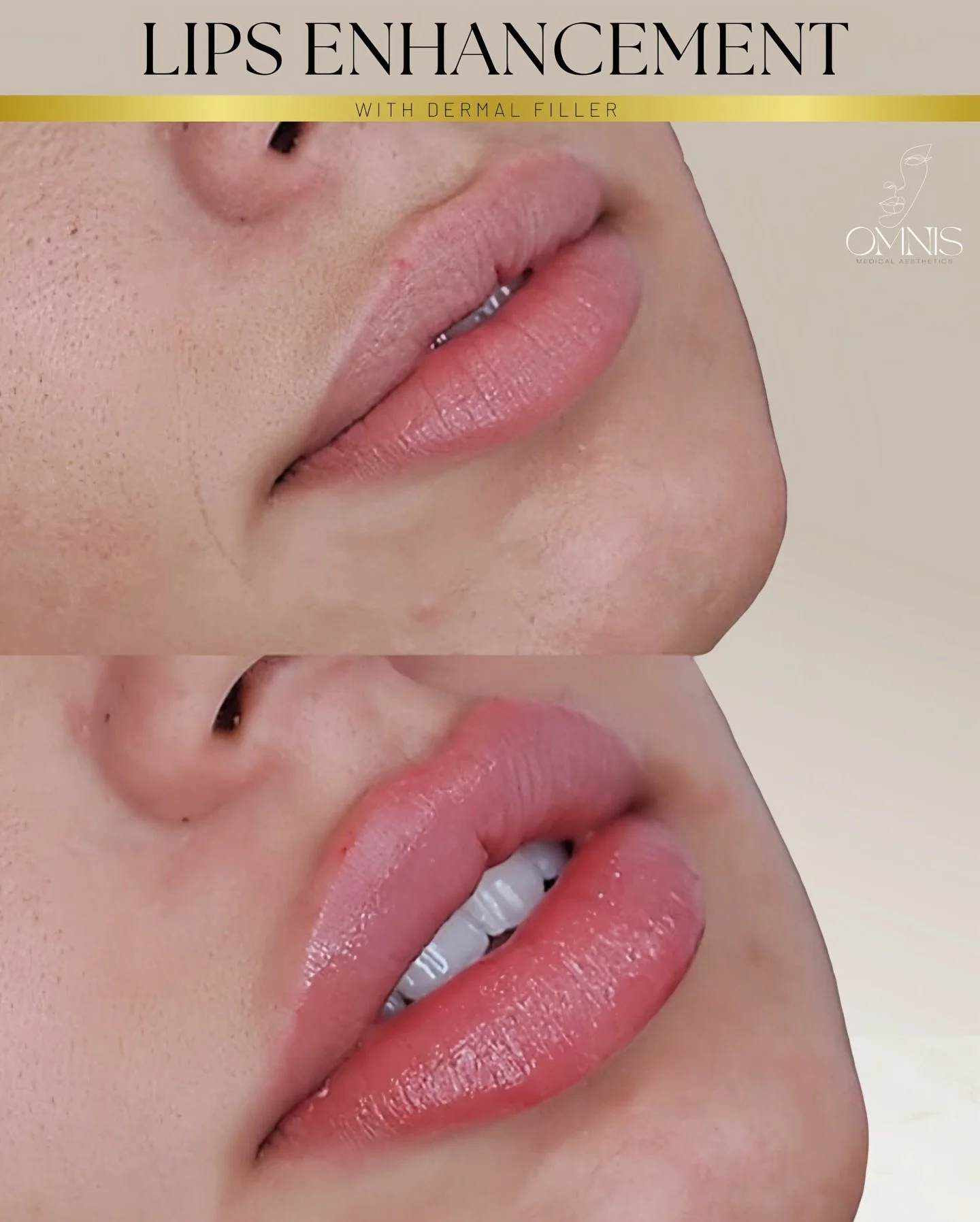 ▪️▪️▪️
Subtle volume. Improved definition. Naturally balanced results.

This treatment is designed to enhance the lips while respecting individual facial proportions. Using premium hyaluronic acid dermal filler, we focus on hydration, contour, and st