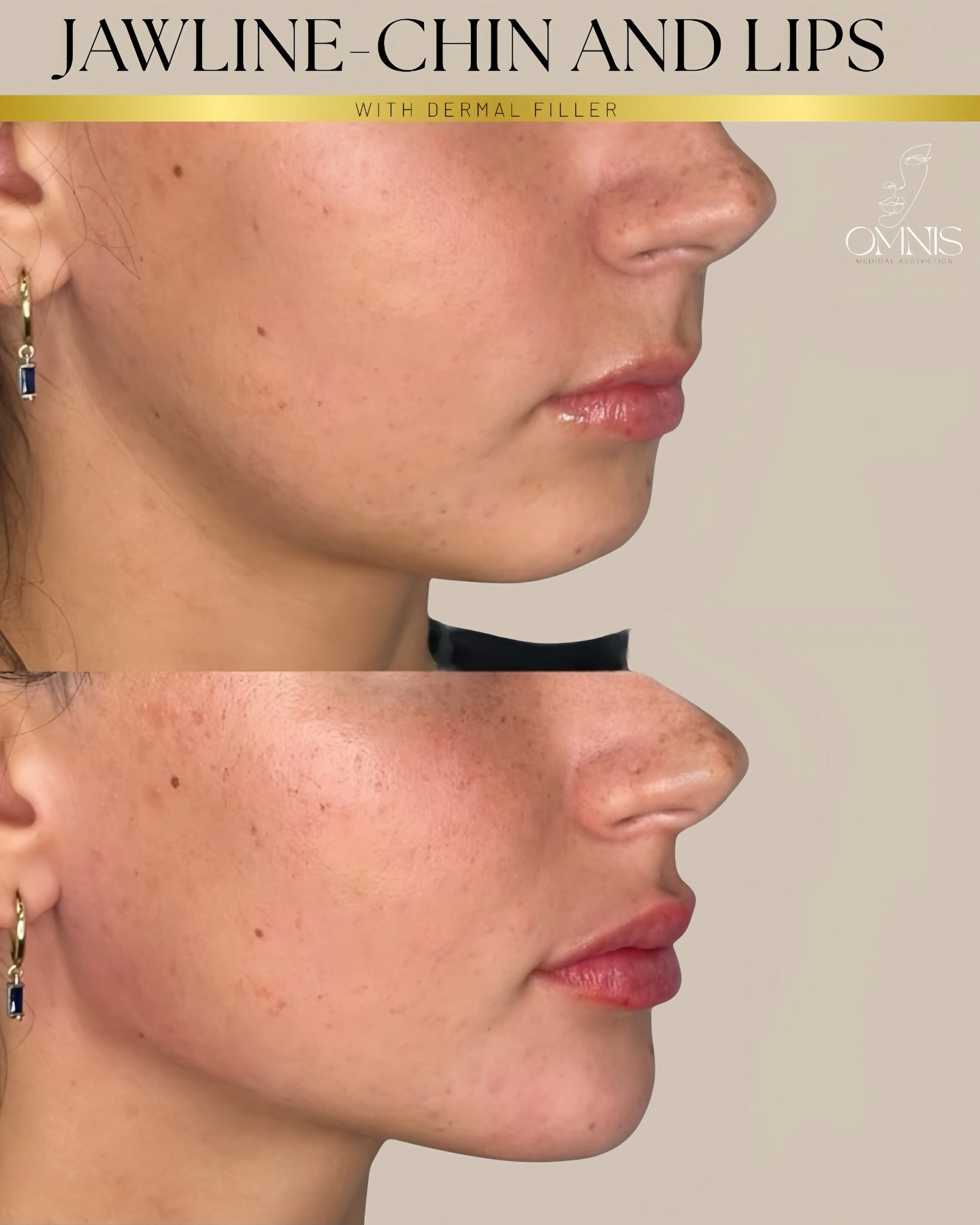 ▪️▪️Lower Face Contour &ndash; Restoring Harmony▪️▪️

With only 3ml of dermal filler, carefully placed in strategic support points (rather than &ldquo;overfilling&rdquo;), we did 
 &bull; refine the jawline
 &bull; strengthen chin projection
 &bull; 