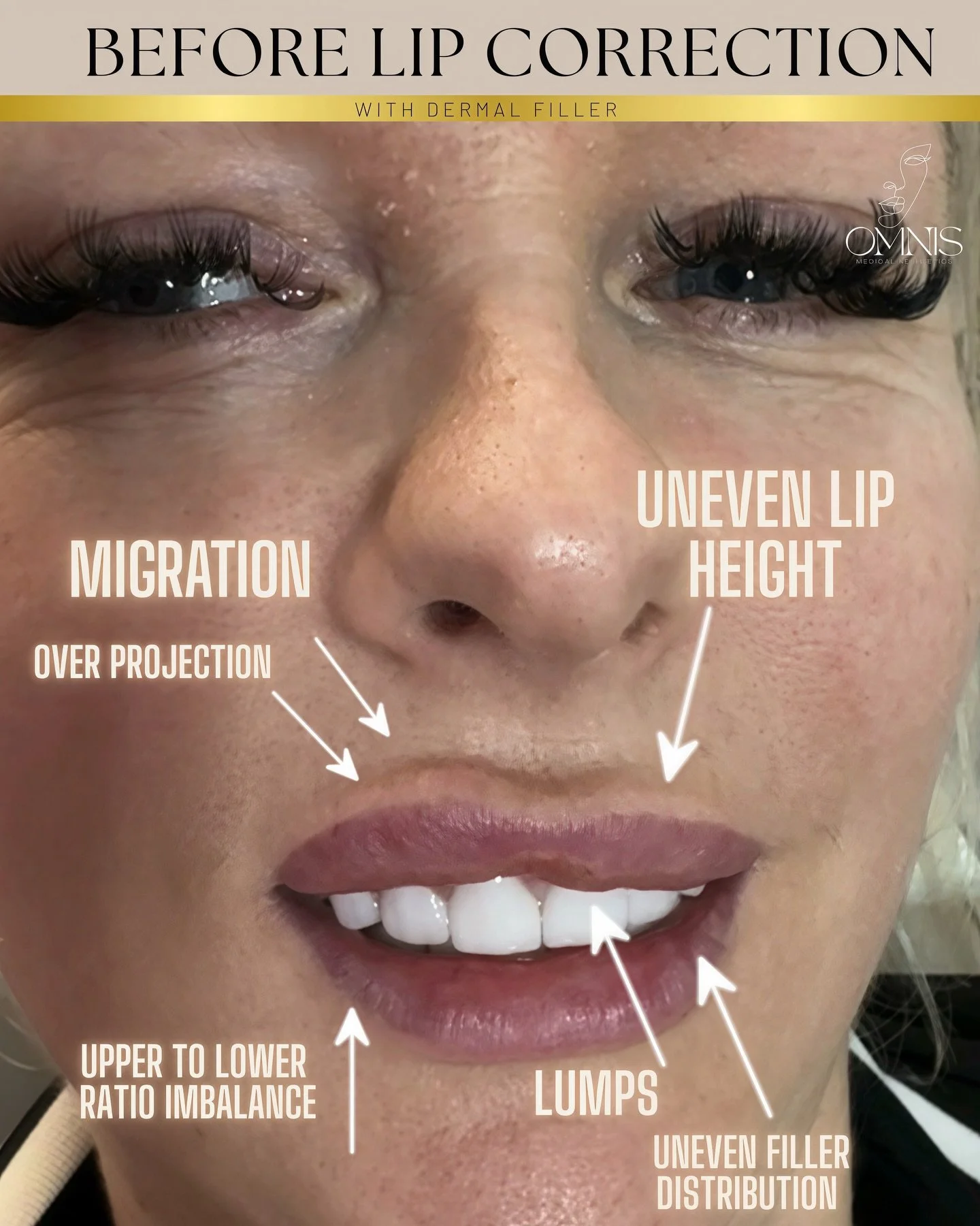 ▪️▪️▪️Lip Correction (no dissolve) ▪️▪️▪️
A new Client came in unhappy with previous filler.
I advised dissolve &amp; rebuild (most predictable), but she didn&rsquo;t want to wait &mdash; so we chose a carefully planned corrective approach instead.

