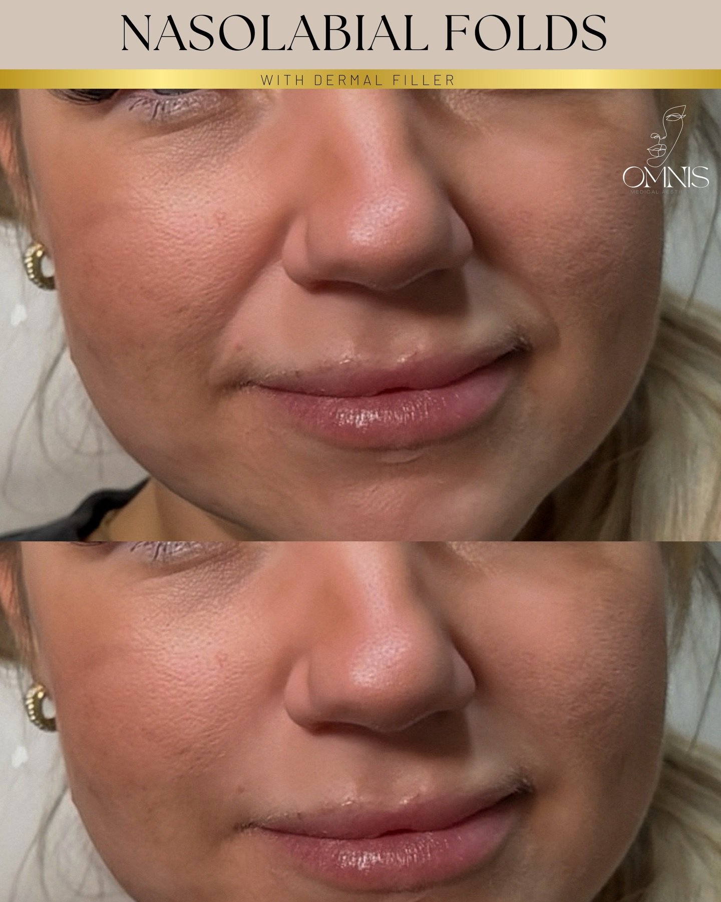 ▪️▪️▪️Nasolabial Fold Softening ▪️▪️▪️

the lines that run from the sides of the nose to the corners of the mouth, can become more pronounced over time due to natural ageing, volume loss, and skin laxity.

This treatment was performed using carefully