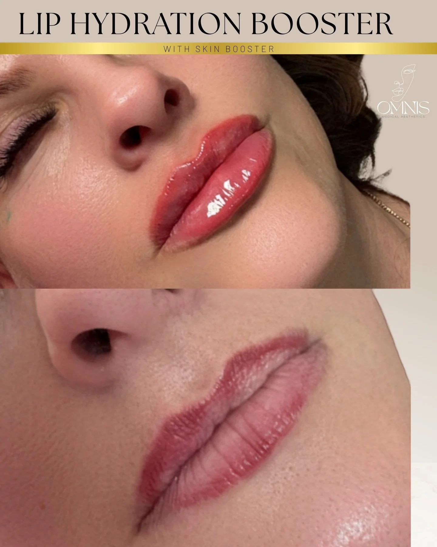 ▪️▪️▪️LIP HYDRATION BOOSTER ▪️▪️▪️💋
Looking for smoother, softer, more hydrated lips without adding filler volume?

Our Lip Hydration Booster is designed to improve lip hydration, texture and overall lip quality using a skin booster approach rather 