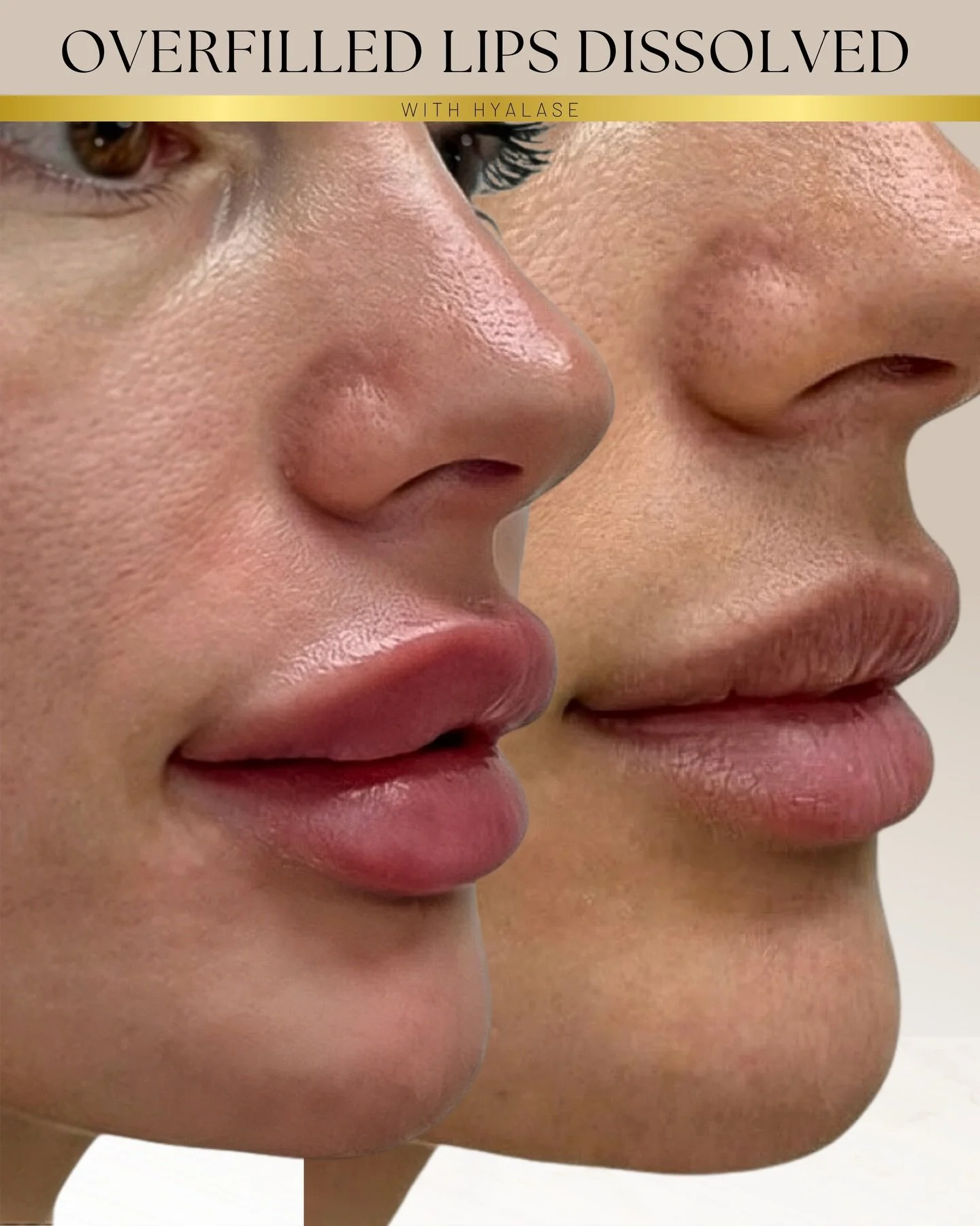 ▪️▪️▪️Choosing your practitioner carefully matters.

Overfilled or poorly placed lip filler can affect both the shape and natural balance of the lips. In some cases, repeated filler treatments without proper assessment can lead to heaviness, migratio