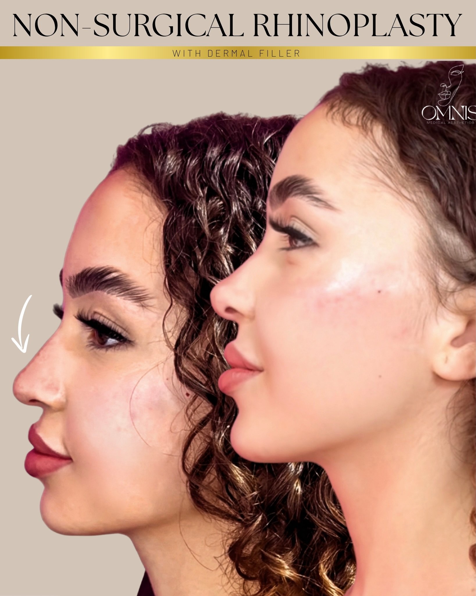 ▪️▪️▪️Non-Surgical Rhinoplasty: Facial Balance &amp; Profile Harmony▪️▪️▪️

Non-surgical rhinoplasty with dermal filler is not about creating a &ldquo;new nose&rdquo; ❌
it is about refining the profile and enhancing overall facial balance.✅

When ass