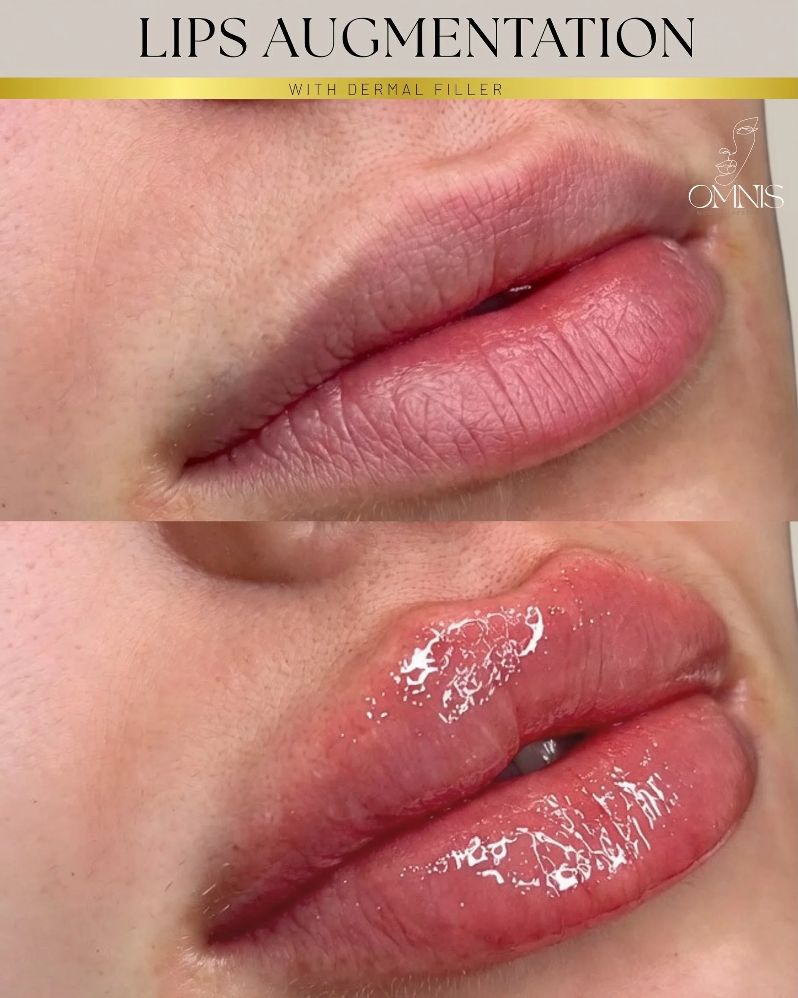 ▪️▪️▪️A beautiful #enhancement focused on shape, #volume and #hydration while keeping the #lips balanced with the client&rsquo;s natural features.

Consultations available at #OMNIS Medical Aesthetics.