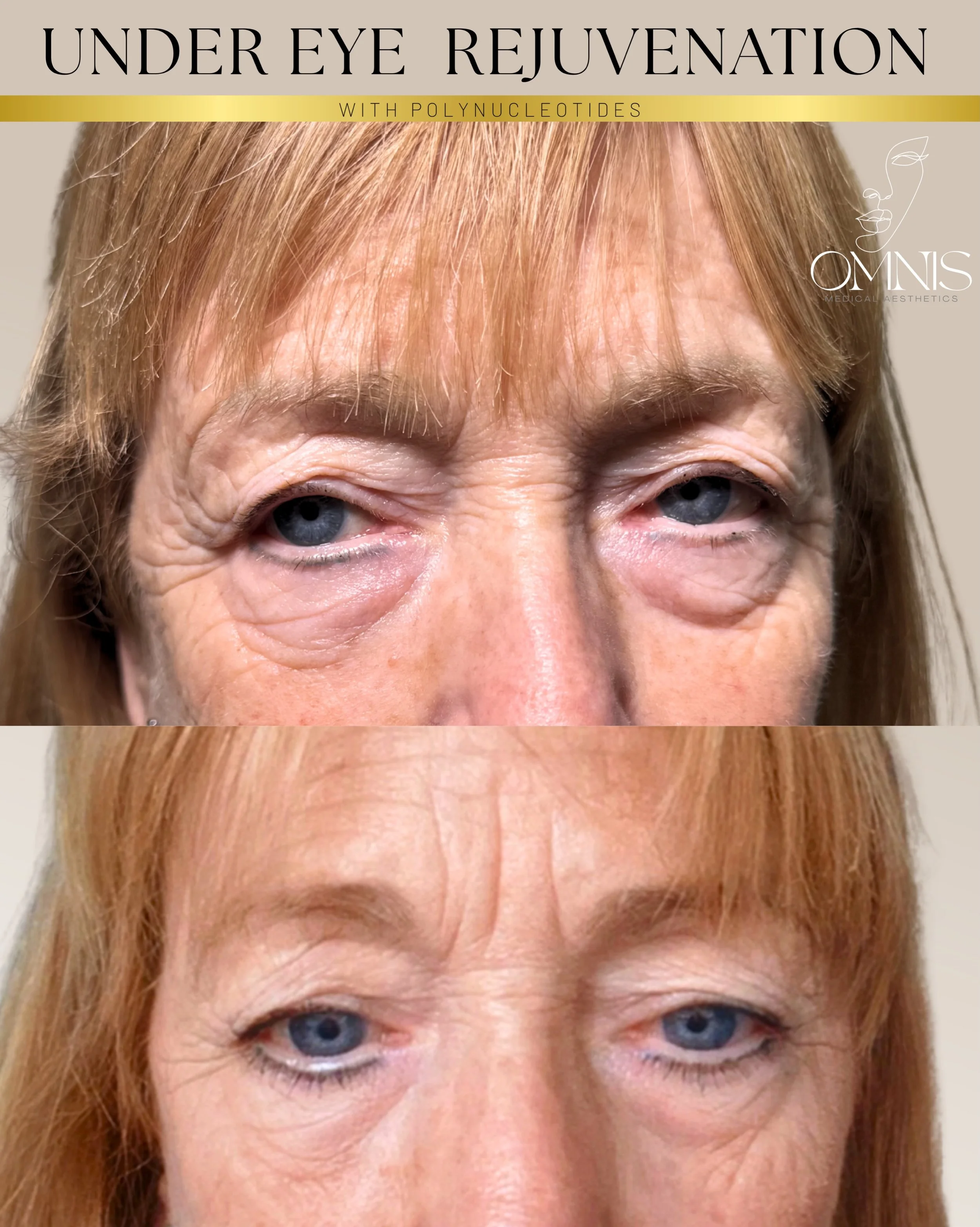 💕💕Just 2 sessions of Polynucleotides 💕💕

Look at the improvement in:
▪️Crepey skin
▪️Under-eye texture
▪️ Overall skin quality

The best aesthetic results don&rsquo;t always come from adding volume.

Sometimes they come from repairing the skin.

