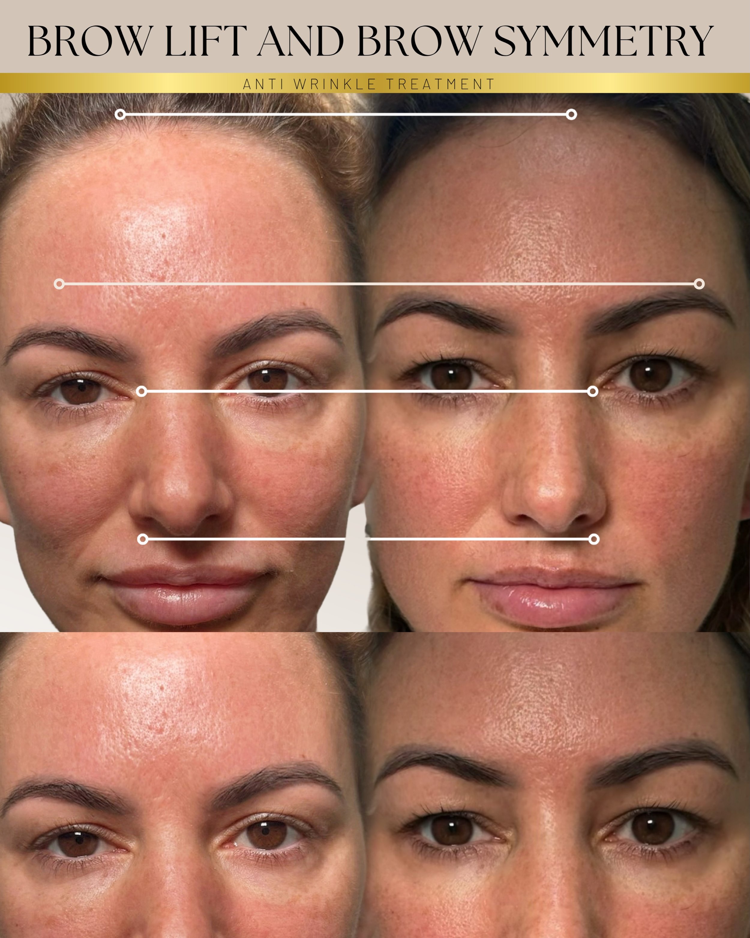 Did you know your face is asymmetrical? 👁️
Almost every face is. One brow sits slightly higher. One eye opens a touch wider. One side carries more tension than the other.
Most people don&rsquo;t notice &mdash; until you show them.
Anti-wrinkle injec