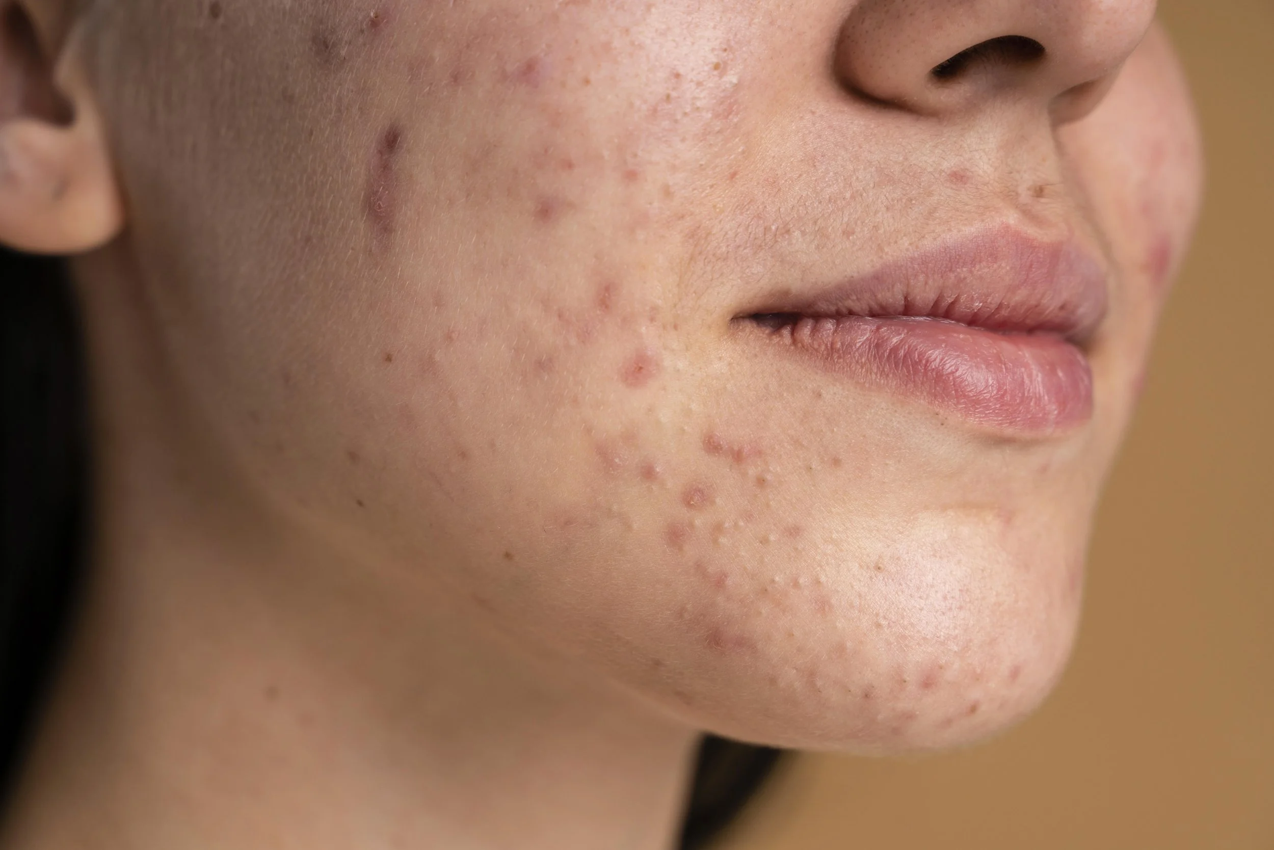 Close-up of a woman's face showing acne and skin inflammation on her cheek and chin.
